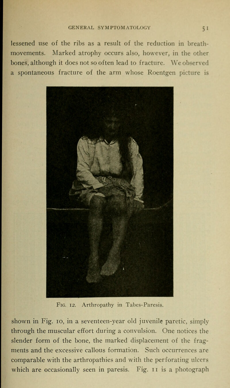 lessened use of the ribs as a result of the reduction in breath- movements. Marked atrophy occurs also, however, in the other bones, although it does not so of ten lead to fracture. Weobserved a spontaneous fracture of the arm whose Roentgen picture is Fig. 12. Arthropathy in Tabes-Paresis. shown in Fig. 10, in a seventeen-year old juvenile paretic, simply through the muscular effort during a convulsion. One notices the slender form of the bone, the marked displacement of the frag- ments and the excessive callous formation. Such occurrences are comparable with the arthropathies and with the perforating ulcers