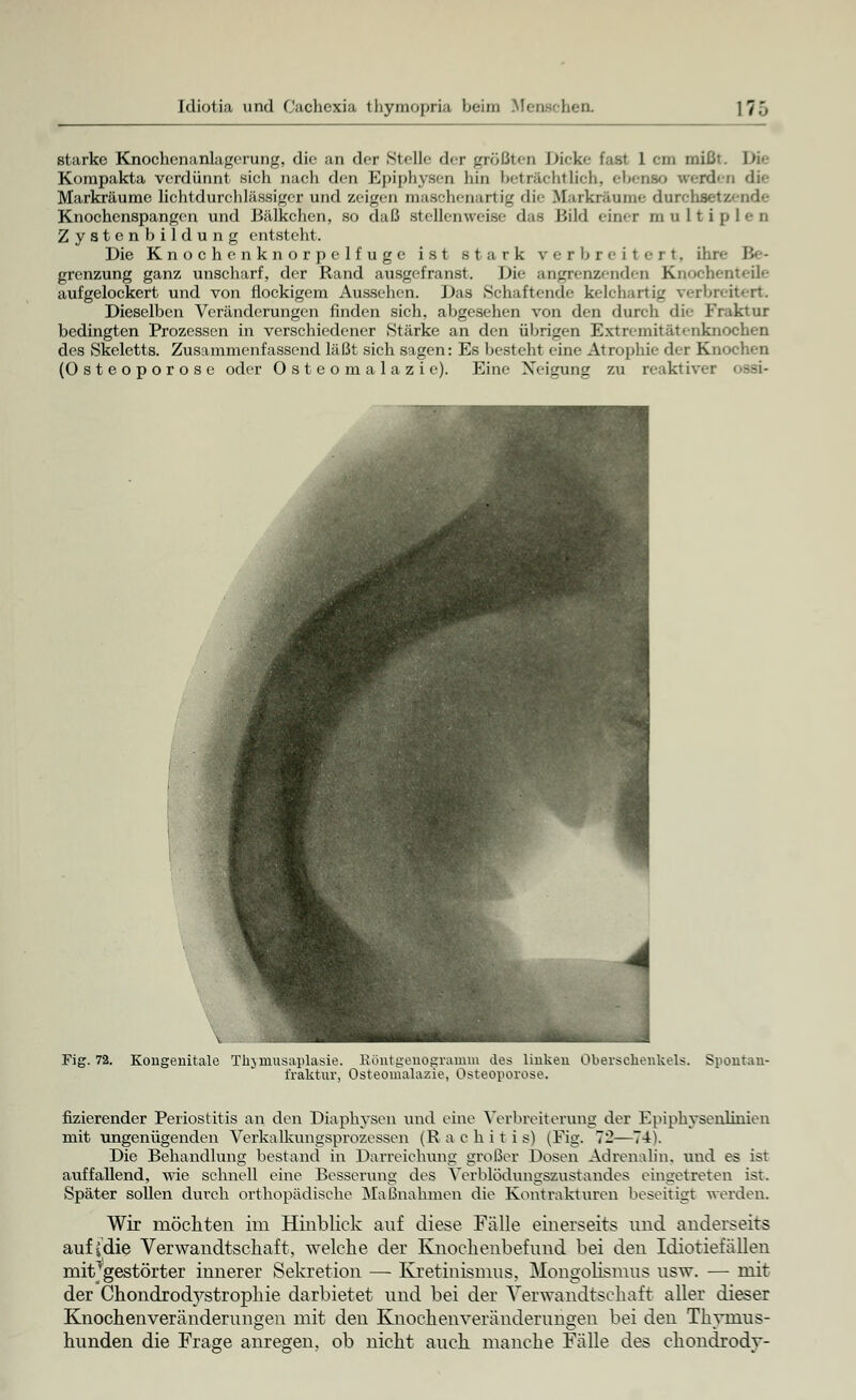 starke Knochenanlagerung, die an der Stelle der größten Dicke bist 1 ein mißt. \n> Korapakta verdünnt sich nach den Epiphysen hin beträchtlich, ebenso werden die Markräume lichtdurchlässiger und zeigen maschenartig die Bfarkrännie durchsetzende Knochenspangen und Bälkchen, so daß stellenweise das Bild einer multiplen Zystenbildung entsteht. Die Knochenknorpelfuge ist stark verbreitert, ihre Be- grenzung ganz unscharf, der Rand ausgefranst. Die angrenzenden Knochenteile aufgelockert und von flockigem Aussehen. Das Schaftende kelchartig verbreitert. Dieselben Veränderungen finden sich, abgesehen von den durch die Fraktur bedingten Prozessen in verschiedener Stärke an den übrigen Extremitatehknochen des Skeletts. Zusammenfassend läßt sieh sagen: Es besteht eine Ai rophie der Knochen (Osteoporose oder Osteomalazie). Eine Xeigung zu reaktiver ossi- Fig. 72. Kongenitale Thjniusaplasie. Röntgenogramm des linken fraktur, Osteomalazie, Osteoporose. kels. Spoutau- fizierender Periostitis an den Diaphysen und eine Verbreiterung der Epiphysenlinien mit ungenügenden Verkalkungsprozessen (Rachitis) (Fig. ~'2—74). Die Behandlung bestand in Darreichung großer Dosen Adrenalin, und es ist auffallend, wie schnell eine Besserung des Verblödungszustandes eingetreten ist. Später sollen durch orthopädische Maßnahmen die Kontrakturen beseitigt werden. Wir möchten im Hinblick auf diese Fälle einerseits und anderseits auf (die Verwandtschaft, welche der Knoclienbefund bei den Idiotiefällen mit^gestörter innerer Sekretion — Kretinismus, Mongolismus usw. — mit der Chondrodystrophie darbietet und bei der Verwandtschaft aller dieser Knochenveränderungen mit den Knochenveränderungen bei den Thvmus- hunden die Frage anregen, ob nicht auch manche Fälle des chondrodv-