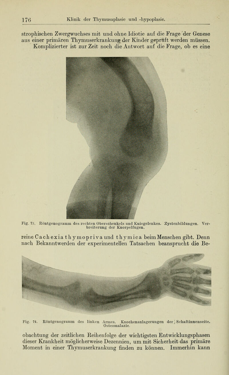 strophischen Zwergwuchses mit und ohne Idiotie auf die Frage der Genese aus einer primären Thymuserkrankung der Kinder geprüft werden müssen. Komplizierter ist zur Zeit noch die Antwort auf die Frage, ob es eine Fig. 73. Röntgenogramm des rechten Oberschenkels und Kniegelenkes. Zystenbildungen. Ver- breiterung der Knorpelfugen. reine Cachexia thymopriva und thymica beim Menschen gibt. Denn nach Bekanntwerden der experimentellen Tatsachen beansprucht die Be- Fig. 74. Röntgenogramm des linken Armes. Knochenanlagerungen der] Schaftinnenseite. Osteomalazie. obachtung der zeitlichen Keihenfolge der wichtigsten Entwicklungsphasen dieser Krankheit möglicherweise Dezennien, um mit Sicherheit das primäre Moment in einer Thymuserkrankung finden zu können. Immerhin kann