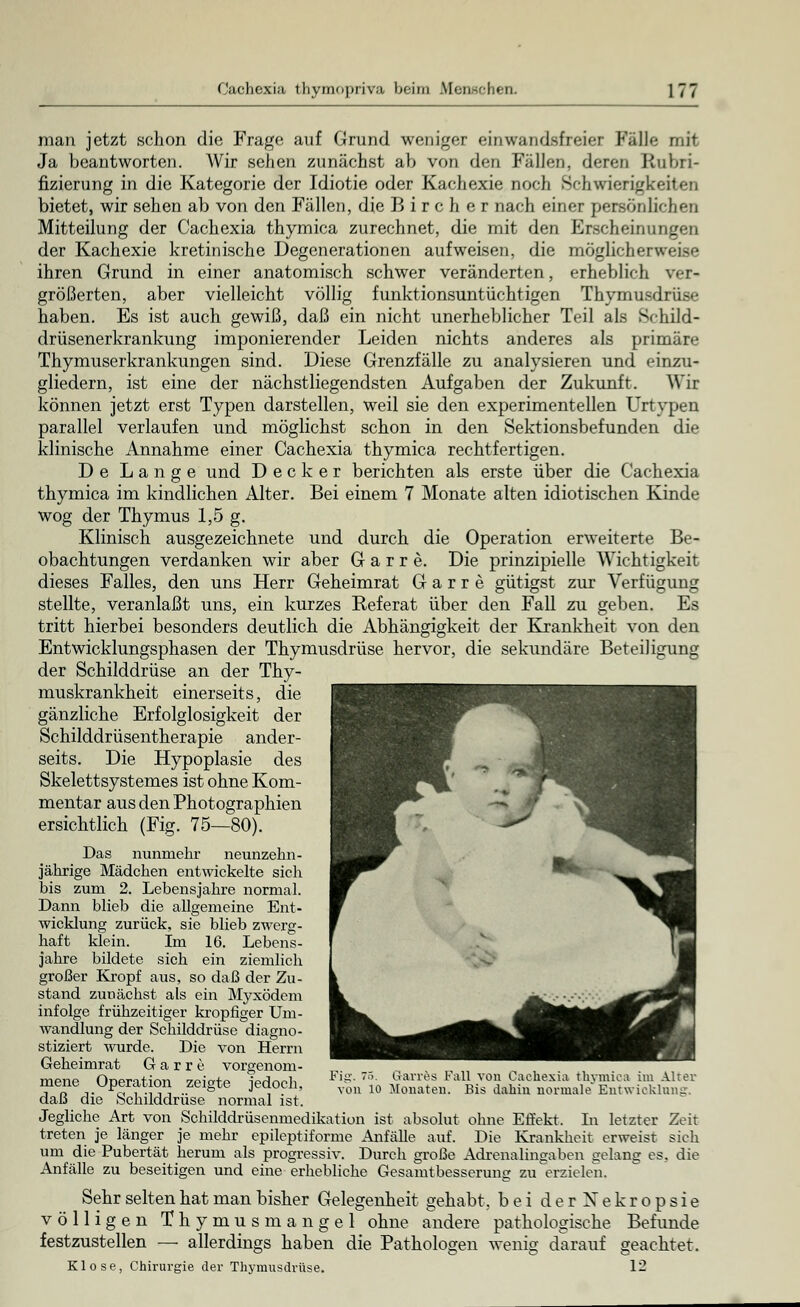 man jetzt schon die Frage auf Grund weniger einwandsfreier Fälle mit Ja beantworten. Wir sehen zunächst ah von den Fällen, deren Rubri- fizierung in die Kategorie der Idiotie oder Kachexie noch Schwierigkeiten bietet, wir sehen ab von den Fällen, die B i r c h e r nach einer persönlichen Mitteilung der Cachexia thymica zurechnet, die mit den Erscheinungen der Kachexie kretinische Degenerationen aufweisen, die möglichere ihren Grund in einer anatomisch schwer veränderten, erheblich ver- größerten, aber vielleicht völlig funktionsuntüchtigen Thymusdrüse haben. Es ist auch gewiß, daß ein nicht unerheblicher Teil als Schild- drüsenerkrankung imponierender Leiden nichts anderes als primäre Thymuserkrankungen sind. Diese Grenzfälle zu analysieren und einzu- gliedern, ist eine der nächstliegendsten Aufgaben der Zukunft. Wir können jetzt erst Typen darstellen, weil sie den experimentellen Urtypen parallel verlaufen und möglichst schon in den Sektionsbefunden die klinische Annahme einer Cachexia thymica rechtfertigen. De Lange und Decker berichten als erste über die Cachexia thymica im kindlichen Alter. Bei einem 7 Monate alten idiotischen Kinde wog der Thymus 1,5 g. Klinisch ausgezeichnete und durch die Operation erweiterte Be- obachtungen verdanken wir aber Garre. Die prinzipielle Wichtigkeit dieses Falles, den uns Herr Geheimrat Garre gütigst zur Verfügung stellte, veranlaßt uns, ein kurzes Referat über den Fall zu geben. Es tritt hierbei besonders deutlich die Abhängigkeit der Krankheit von den Entwicklungsphasen der Thymusdrüse hervor, die sekundäre Beteiligung der Schilddrüse an der Thy- muskrankheit einerseits, die gänzliche Erfolglosigkeit der Schilddrüsentherapie ander- seits. Die Hypoplasie des Skelettsystemes ist ohne Kom- mentar aus den Photographien ersichtlich (Fig. 75—80). Das nunmehr neunzehn- jährige Mädchen entwickelte sich bis zum 2. Lebensjahre normal. Dann blieb die allgemeine Ent- wicklung zurück, sie blieb zwerg- haft klein. Im 16. Lebens- jahre bildete sich ein ziemlich großer Kropf aus, so daß der Zu- stand zunächst als ein Myxödem infolge frühzeitiger kropfiger Um- wandlung der Schilddrüse diagno- stiziert wurde. Die von Herrn Geheimrat Garre vorgenom- mene Operation zeigte jedoch, daß die Schilddrüse normal ist. Jegliche Art von Schilddrüsenmedikation ist absolut ohne Effekt. In letzter Zeit treten je länger je mehr epileptiformc Anfälle auf. Die Ivrankhcit erweist sich um die Pubertät herum als progressiv. Durch große Adrenalingaben gelang es. die Anfälle zu beseitigen und eine erhebliche Gesamtbesserung zu erzielen. Sehr selten hat man bisher Gelegenheit gehabt, bei derXekropsie völligen Thymusmangel ohne andere pathologische Befimde festzustellen — allerdings haben die Pathologen wenig darauf geachtet. Klose, Chirurgie der Thymusdrüse. 12 Fig. 75. G-arres Fall von Cachexia thymica im Alter von 10 Monaten. Bis dahin normale Entwicklung.