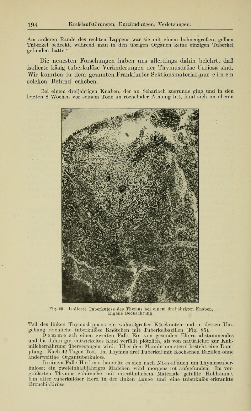 Am äußeren Rande des rechten Lappens war sie mit einem bohnengroßen, gelben Tuberkel bedeckt, während man in den übrigen Organen keine einzigen Tuberkel gefunden hatte. Die neuesten Forschungen haben uns allerdings dahin belehrt, daß isolierte käsig tuberkulöse Veränderungen der Thymusdrüse Curiosa sind. Wir konnten in dem gesamten Frankfurter Sektionsmaterial nur einen solchen Befund erheben. Bei einem dreijährigen Knaben, der an Scharlach zugrunde ging und in den letzten 8 Wochen vor seinem Tode an röchelnder Atmung litt, fand sich im oberen Fig. 86. Isolierte Tuberkulose des Thymus bei einem dreijährigen Knaben. Eigene Beobachtung. Teil des linken Thymuslappens ein walnußgroßer Käseknoten und in dessen Um- gebung reichliche tuberkulöse Knötchen mit Tuberkelbazillen (Fig. 85). D e m m e sah einen zweiten Fall: Ein von gesunden Eltern abstammendes und bis dahin gut entwickeltes Kind verfällt plötzlich, als von natürlicher zur Kuh- milchernährung übergegangen wird. Über dem Manubrium sterni besteht eine Däm- pfung. Nach 42 Tagen Tod. Im Thymus drei Tuberkel mit Kochschen Bazillen ohne anderweitige Organtuberkulose. In einem Falle Helms handelte es sich nach Niesei auch um Thymustuber- kulose: ein zweieinhalb jähriges Mädchen wird morgens tot aufgefunden. Im ver- größerten Thymus zahlreiche mit eiterähnlichem Materiale gefüllte Hohlräume. Ein alter tuberkulöser Herd in der linken Lunge und eine tuberkulös erkrankte Bronchialdrüse.