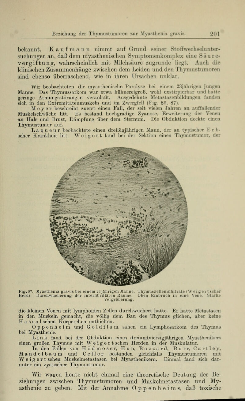 bekannt. Kaufmann nimmt auf Grund seiner Stoffwechßelunter- suchungen an, daß dem myasthenischen Symptomenkomplex eine Säure« Vergiftung, wahrscheinlich mit Mildisiiure zugrunde liegt. Auch die klinischen Zusammenhänge zwischen dem Leiden und den Thymusi sind ebenso überraschend, wie in ihren Ursachen unklar. Wir beobachteten die myasthenische Paralyse bei einem 23jährigen | Manne. Das Thymussarkom war etwa hühnereigroß, wohl exstirpiefbai and hatte geringe Atmungsstörung.n veranlaßt. Ausgedehnte Metastasenlnl<luir_'on fand D sich in den Extremitätenmuskeln und im Zwergfell (Fip. 8'i. 87). Meyer beschreibt zuerst einen Fall, der seit vielen Jahren an auffallender Muskelschwäche litt. Es bestand hochgradige Zyanose, Erweiterung der \ an Hals und Brust, Dämpfung über dem Sternum. Die Obduktion deckte einen Thymustumor auf. Laqueur beobachtete einen dreißigjährigen Mann, der an typischer Erb- scher Krankheit litt. Weigert fand bei der Sektion einen Thymustumor. der m Fig. 87. Myasthenia gravis bei einem 23jährigen Manne Herd). Durchwucherung der internbrillären Räume, Vergrößerung Thymuszelleninfiltrate (W eigert scher Oben Einbruch in eine Vene Starke die kleinen Venen mit lymphoiden Zellen durchwuchert hatte. Fr hatte Metastasen in den Muskeln gemacht, die völlig dem Bau des Thymus glichen, aber keine H a s s a 1 sehen Körperchen enthielten. Oppenheim ttnd Goldflam sahen ein Lymphosarkom des Thymus bei Myasthenie. Link fand bei der Obduktion eines dreiundvierzig jährigen Myasthenikers einen großen Thymus mit Weigert sehen Herden in der Muskulatur. In den Fällen von Hödmoser, H u n, B u z z a r d. B u r r. C a r 11 e y. Mandelbaum und C e 11 e r bestanden gleichfalls Thymustumoren mit Weigert sehen Muskelmetastasen bei Myasthenikern. Einmal fand sieh dar- unter ein zystischer Thymustumor. Wir wagen heute nicht einmal eine theoretische Deutung der Be- ziehungen zwischen Thymustumoren und Muskelmetastasen und My- asthenie zu geben. Mit der Annahme Oppenheims, daß toxische