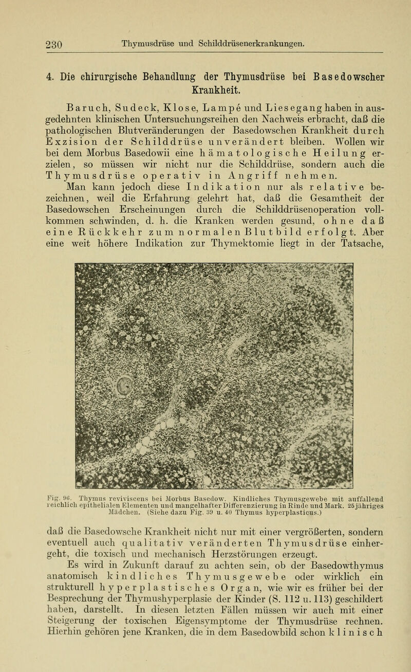 4. Die chirurgische Behandlung der Thymusdrüse bei Basedowscher Krankheit. Baruch, Sudeck, Klose, Lampe und Liesegang haben in aus- gedehnten klinischen Untersuchungsreihen den Nachweis erbracht, daß die pathologischen Blutveränderungen der Basedowschen Krankheit durch Exzision der Schilddrüse unverändert bleiben. Wollen wir bei dem Morbus Basedowii eine hämatologische Heilung er- zielen, so müssen wir nicht nur die Schilddrüse, sondern auch die Thymusdrüse operativ in Angriff nehmen. Man kann jedoch diese Indikation nur als relative be- zeichnen, weil die Erfahrung gelehrt hat, daß die Gesamtheit der Basedowschen Erscheinungen durch die Schilddrüsenoperation voll- kommen schwinden, d. h. die Kranken werden gesund, ohne daß eine Rückkehr zum normalen Blutbild erfolgt. Aber eine weit höhere Indikation zur Thymektomie liegt in der Tatsache, Fig. 9(3. Thymus revivisceiis bei Morbus Basedow. Kindliches Thymusgewebe mit auffallend reichlich epithelialen Elementen und mangelhafter Differenzierung in Rinde und Mark. 25 jahriges Mädchen. (Siehe dazu Fig. 39 u. 40 Thymus hyperplasticus.) daß die Basedowsche Krankheit nicht nur mit einer vergrößerten, sondern eventuell auch qualitativ veränderten Thymusdrüse einher- geht, die toxisch und mechanisch Herzstörungen erzeugt. Es wird in Zukunft darauf zu achten sein, ob der Basedowthymus anatomisch kindliches Thymusgewebe oder wirklich ein strukturell hyperplastisches Organ, wie wir es früher bei der Besprechung der Thymushyperplasie der Kinder (S. 112 u.113) geschildert haben, darstellt. In diesen letzten Fällen müssen wir auch mit einer Steigerung der toxischen Eigensymptome der Thymusdrüse rechnen. Hierhin gehören jene Kranken, die in dem Basedowbild schon klinisch
