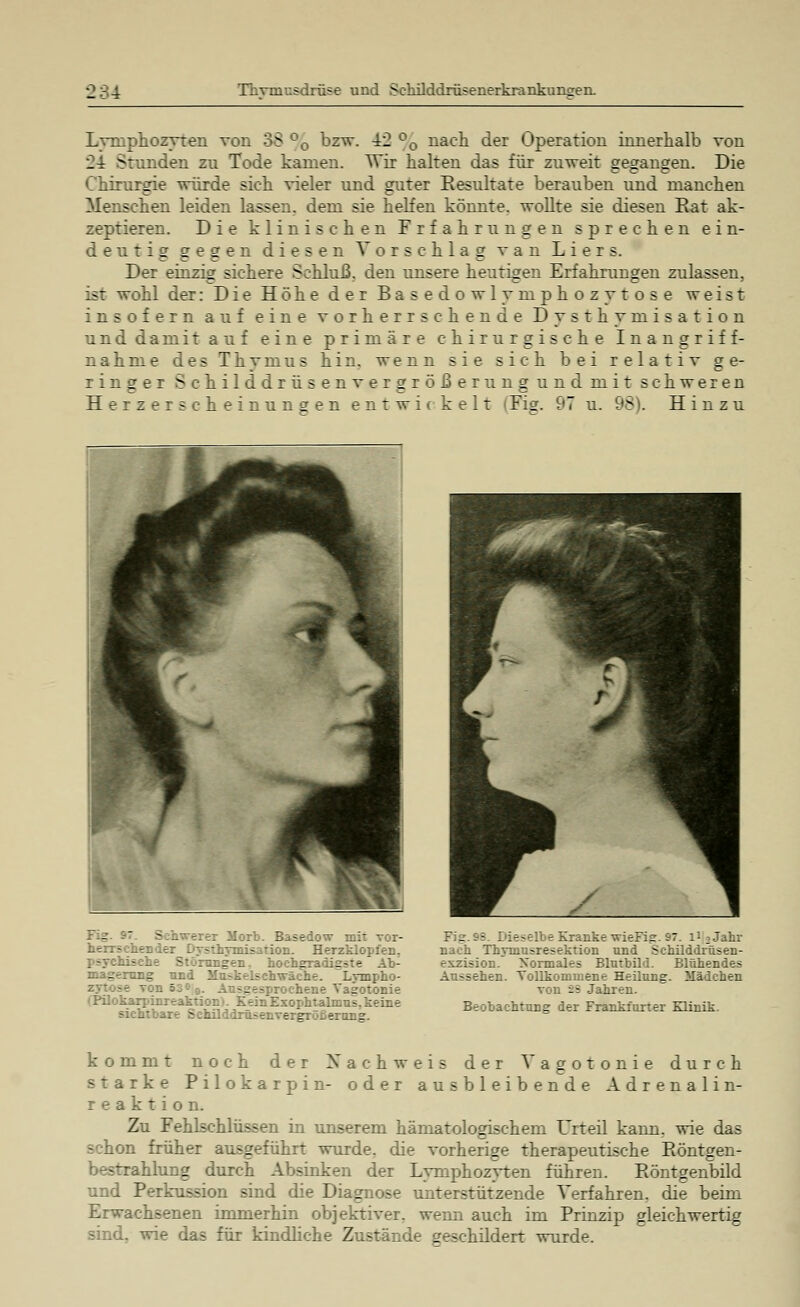Lyinphozyten von 38 °0 bzw. ±2 °0 nach der Operation innerlialb von 24 Stunden zu Tode kanien. Wir halten das für zu weit gegangen. Die Chirurgie würde sich vieler und guter Resultate berauben und manchen Menschen leiden lassen, dem sie helfen könnte, wollte sie diesen Rat ak- zeptieren. Die klinischen Frfahrungen sprechen ein- deutig gegen diesen Vorschlag van Liers. Der einzig sichere Schluß, den unsere heutigen Erfahrungen zulassen. ist wohl der: Die Höhe der Basedowlymphozytose weist insofern auf eine vorherrschende Dysthymisation und damit auf eine primäre chirurgische Inangriff- nahme des Thymus hin. wenn sie sich bei relativ ge- ringer Schilddrüsenvergrößerung und mit schweren Herzerscheinungen entwi( kelt (Fig. 97 u. 98). Hinzu rr Morb. Basedow mit vor- herrschender DTSthymisaTion. HerzklopfeD. - d hochgradigste Ab- -7. Lympho- - - -• :tonie fPilokarpii:: -::-Zsophtalmui. keine IrüsenvergTüfierang. Fig.95. Dieselbe Kranke wieFig. 97. li^Jahr nach Thymusresektion und Sehilddrüsen- eizision. Normales Blutbild. Blühendes Aussehen. Vollkommene Heilung. Mädchen von 2S Jahren. Beobachtung der Frankfurter Klinik. kommt noch der Nachweis der Vagotonie durch starke Pilokarpin- oder ausbleibende Adrenalin- reaktion. Zu Fehlschlüssen in unserem hämatologischem Urteil kann, wie das m früher ausgeführt wurde, die vorherige therapeutische Röntgen- rahlung durch Absinken der Lymphozyten führen. Röntgenbild und Perkussion sind die Diagnose unterstützende Verfahren, die beim ?-chsenen immerhin objektiver, wenn auch im Prinzip gleichwertig sind., wie das für kindliche Zustände geschildert wurde.