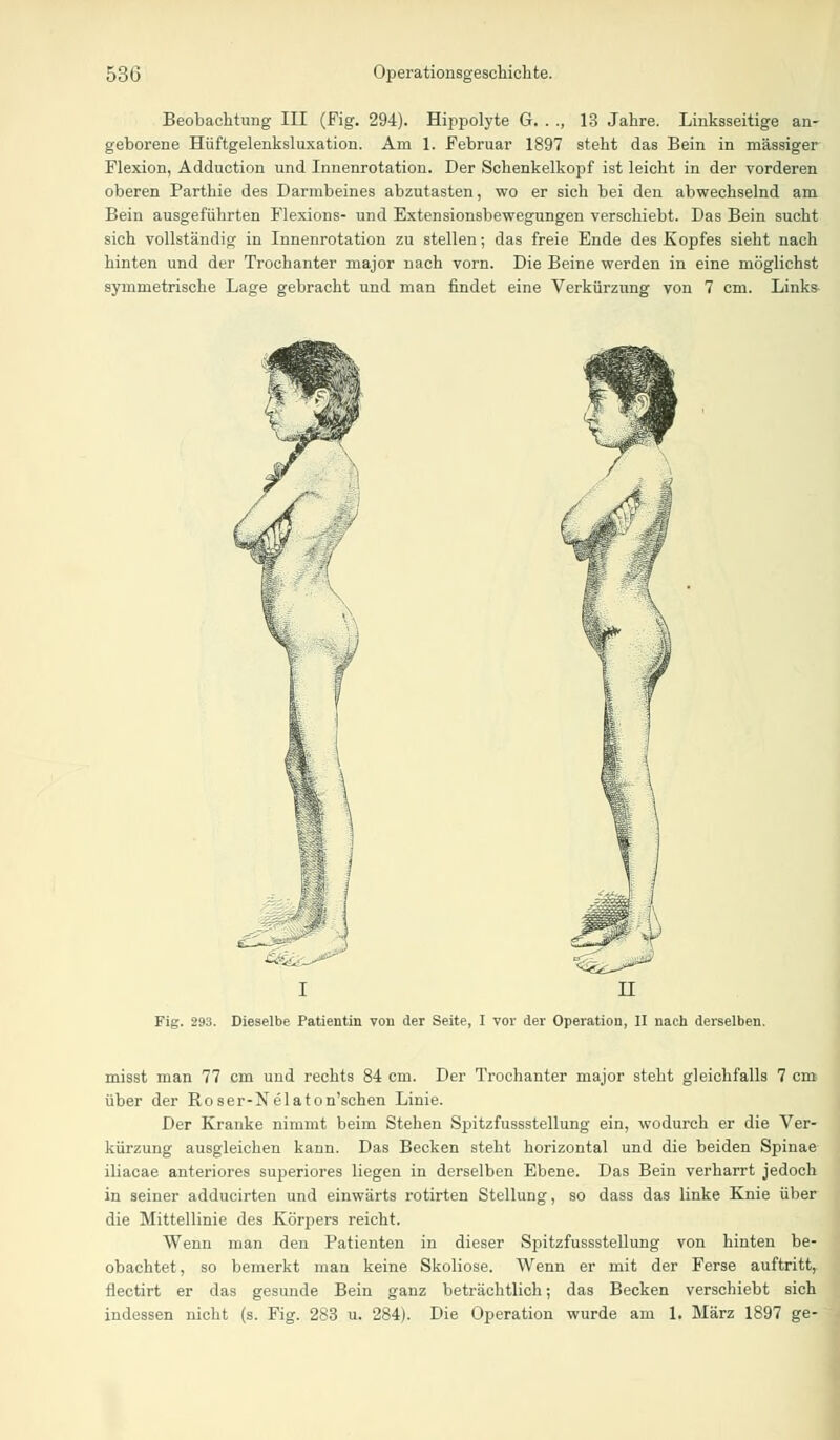 Beobachtung III (Fig. 294). Hippolyte G. . ., 13 Jahre. Linksseitige an- geborene Hüftgelenksluxation. Am 1. Februar 1897 steht das Bein in massiger Flexion, Adduction und Innenrotation. Der Schenkelkopf ist leicht in der vorderen oberen Parthie des Darmbeines abzutasten, wo er sich bei den abwechselnd am Bein ausgeführten Flexions- und Extensionsbewegungen verschiebt. Das Bein sucht sich vollständig in Innenrotation zu stellen; das freie Ende des Kopfes sieht nach hinten und der Trochanter major nach vorn. Die Beine werden in eine möglichst symmetrische Lage gebracht und man findet eine Verkürzung von 7 cm. Links I II Fig. 293. Dieselbe Patientin vou der Seite, I vor der Operation, II nach derselben. misst man 77 cm und rechts 84 cm. Der Trochanter major steht gleichfalls 7 cm über der Roser-Nelaton'sehen Linie. Der Kranke nimmt beim Stehen Spitzfussstellung ein, wodurch er die Ver- kürzung ausgleichen kann. Das Becken steht horizontal und die beiden Spinae iliacae anteriores superiores liegen in derselben Ebene. Das Bein verharrt jedoch in seiner adducirten und einwärts rotirten Stellung, so dass das linke Knie über die Mittellinie des Körpers reicht. Wenn man den Patienten in dieser Spitzfussstellung von hinten be- obachtet, so bemerkt man keine Skoliose. Wenn er mit der Ferse auftritt, flectirt er das gesunde Bein ganz beträchtlich; das Becken verschiebt sich indessen nicht (s. Fig. 283 u. 284). Die Operation wurde am 1. März 1897 ge-