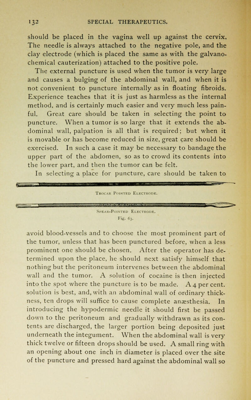 should be placed in the vagina well up against the cervix. The needle is always attached to the negative pole, and the clay electrode (which is placed the same as with the galvano- chemical cauterization) attached to the positive pole. The external puncture is used when the tumor is very large and causes a bulging of the abdominal wall, and when it is not convenient to puncture internally as in floating fibroids. Experience teaches that it is just as harmless as the internal method, and is certainly much easier and very much less pain- ful. Great care should be taken in selecting the point to puncture. When a tumor is so large that it extends the ab- dominal wall, palpation is all that is required; but when it is movable or has become reduced in size, great care should be exercised. In such a case it may be necessary to bandage the upper part of the abdomen, so as to crowd its contents into the lower part, and then the tumor can be felt. In selecting a place for puncture, care should be taken to Trocar Pointed Electrode. ^aieg^qaflSBMlfl—lir i Spear-Pointed Electrode. Fig. 63. avoid blood-vessels and to choose the most prominent part of the tumor, unless that has been punctured before, when a less prominent one should be chosen. After the operator has de- termined upon the place, he should next satisfy himself that nothing but the peritoneum intervenes between the abdominal wall and the tumor. A solution of cocaine is then injected into the spot where the puncture is to be made. A 4 per cent, solution is best, and, with an abdominal wall of ordinary thick- ness, ten drops will suffice to cause complete anaesthesia. In introducing the hypodermic needle it should first be passed down to the peritoneum and gradually withdrawn as its con- tents are discharged, the larger portion being deposited just underneath the integument. When the abdominal wall is very thick twelve or fifteen drops should be used. A small ring with an opening about one inch in diameter is placed over the site of the puncture and pressed hard against the abdominal wall so