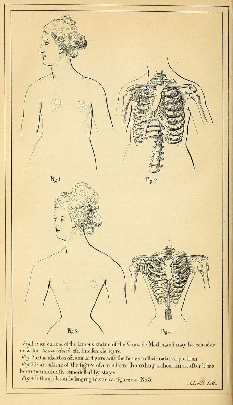 /'i</1 is an oufline of the famous statue df Hie Venus de Mediri,and may te consider- ed a-s the beau ideal ofa line (en.rn.lefigure. /''/ 2. istjie skeleton cf& similar figure/with (lie bones in their 11<\( ura] position. /'7//'i is kj i oi/IJ i ne of the figure of a modern i)oarding-sc]ioo]iui!is','afterit'lias been peimaiiently tramDctaTled hj stays. /''<y./|. is lliu.ski'lrldii kloiifiihjitosm'ha T^m-cas No.5 „ . .,/,,,