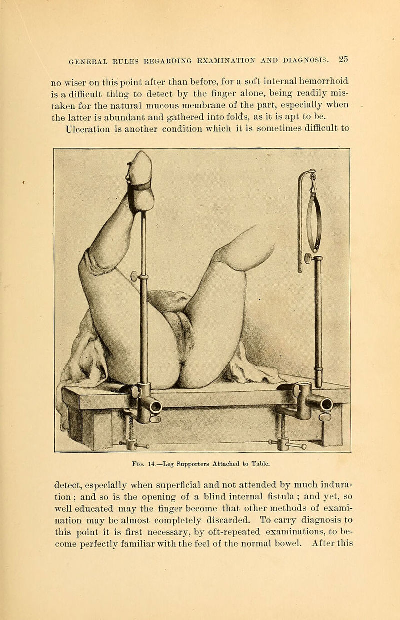 no wiser on this point after than before, for a soft internal hemorrhoid is a difficult thing to detect by the finger alone, being readily mis- taken for the natural mucous membrane of the part, especially when the latter is abundant and gathered into folds, as it is apt to be. Ulceration is another condition which it is sometimes difficult to Fig. 14.—Leg Supporters Attached to Table. detect, especially when superficial and not attended by much indura- tion ; and so is the opening of a blind internal fistula; and yet, so well educated may the finger become that other methods of exami- nation may be almost completely discarded. To carry diagnosis to this point it is first necessary, by oft-repeated examinations, to be- come perfectly familiar with the feel of the normal bowel. After this