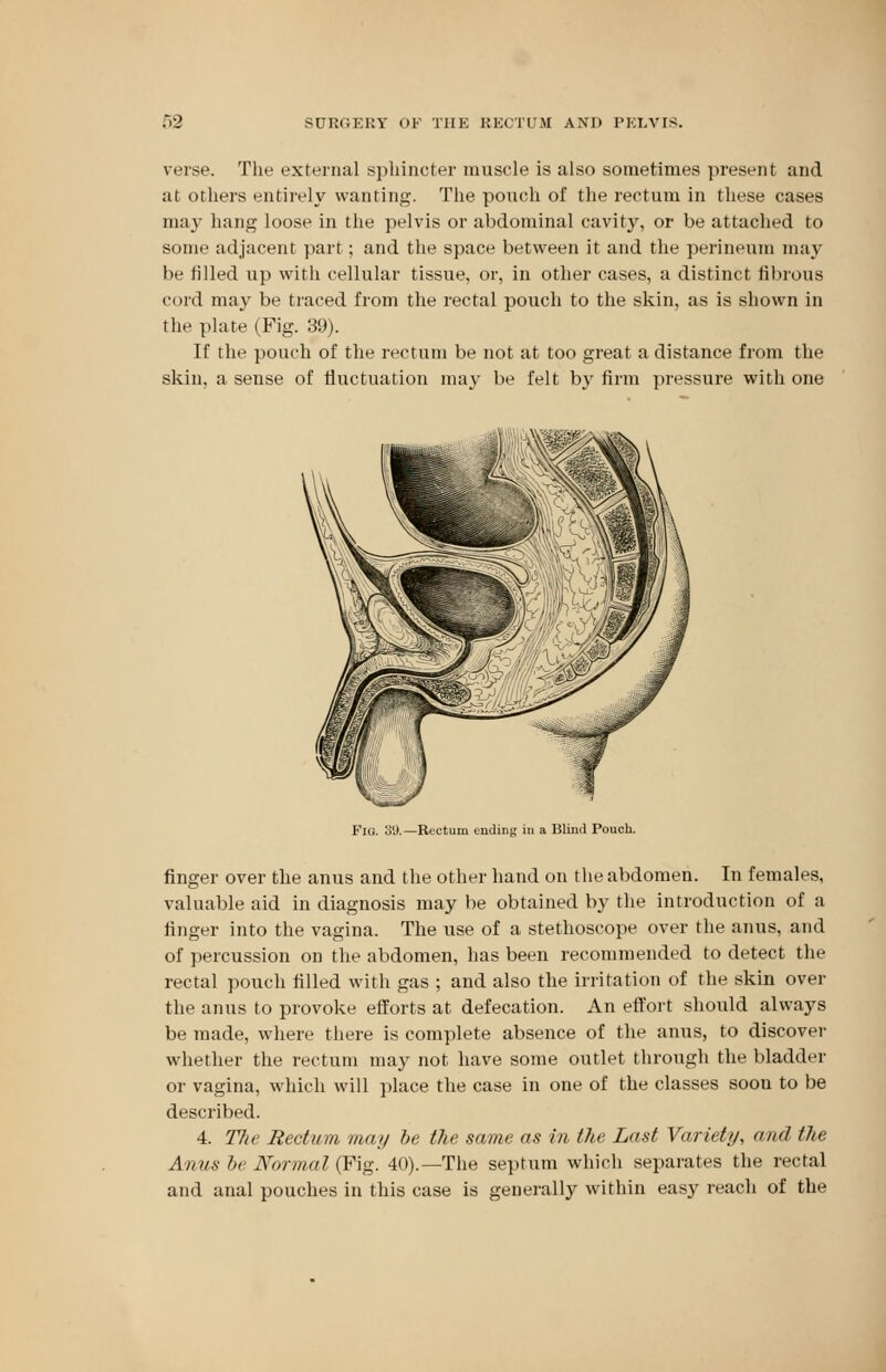 62 sui:<;ki:y of the kkcti'.m a\i> PELVIS. verse. The external sphincter muscle is also sometimes present and al others entirely wanting. The pouch of the rectum in these cases may hang loose in the pelvis or abdominal cavity, or be attached to some adjacent part; and the space between it and the perineum may be tilled up with cellular tissue, or, in other cases, a distinct fibrous cord may be traced from the rectal pouch to the skin, as is shown in the plate (Fig. 39). If the pouch of the rectum be not at too great a distance from the skin, a sense of fluctuation may be felt by firm pressure with one Fio. 3'J.—Rectum ending in a Blind Pouch. finger over the anus and the other hand on the abdomen. In females, valuable aid in diagnosis may be obtained by the introduction of a finger into the vagina. The use of a stethoscope over the anus, and of percussion on the abdomen, has been recommended to detect the rectal pouch filled with gas ; and also the irritation of the skin over the anus to provoke efforts at defecation. An effort should always be made, where there is complete absence of the anus, to discover whether the rectum may not have some outlet through the bladder or vagina, which will place the case in one of the classes soon to be described. 4. TJw Rectum may be the same as in the Last Variety, and the Anus be Normal (Fig. 40).—The septum which separates the rectal and anal pouches in this case is generally within easy reach of the