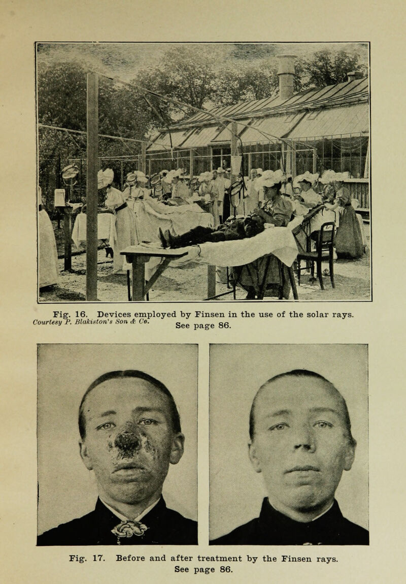 Fig. 16. Devices employed by Finsen in the use of the solar rays. Courtesy P. BlakMon'a Son it Ce. _ „„ Fig. 17. Before and after treatment by the Finsen rays. See page 86.