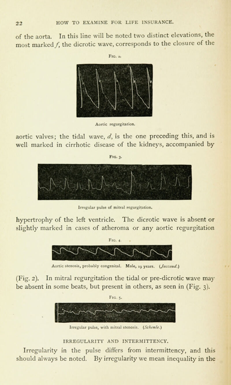 of the aorta. In this line will be noted two distinct elevations, the most marked/, the dicrotic wave, corresponds to the closure of the Fig. Aortic regurgitation. aortic valves; the tidal wave, </, is the one preceding this, and is well marked in cirrhotic disease of the kidneys, accompanied by Fig. 3. Irregular pulse of mitral regurgitation. hypertrophy of the left ventricle. The dicrotic wave is absent or slightly marked in cases of atheroma or any aortic regurgitation Fig. 4 Aortic stenosis, probably congenital. Male, 19 years. (Jaccoud.) (Fig. 2). In mitral regurgitation the tidal or pre-dicrotic wave may be absent in some beats, but present in others, as seen in (Fig. 3). Fig. 5. Irregular pulse, with mitral stenosis. (Sc/ienle.) IRREGULARITY AND INTERMITTENCY. Irregularity in the pulse differs from intermittency, and this should always be noted. By irregularity we mean inequality in the
