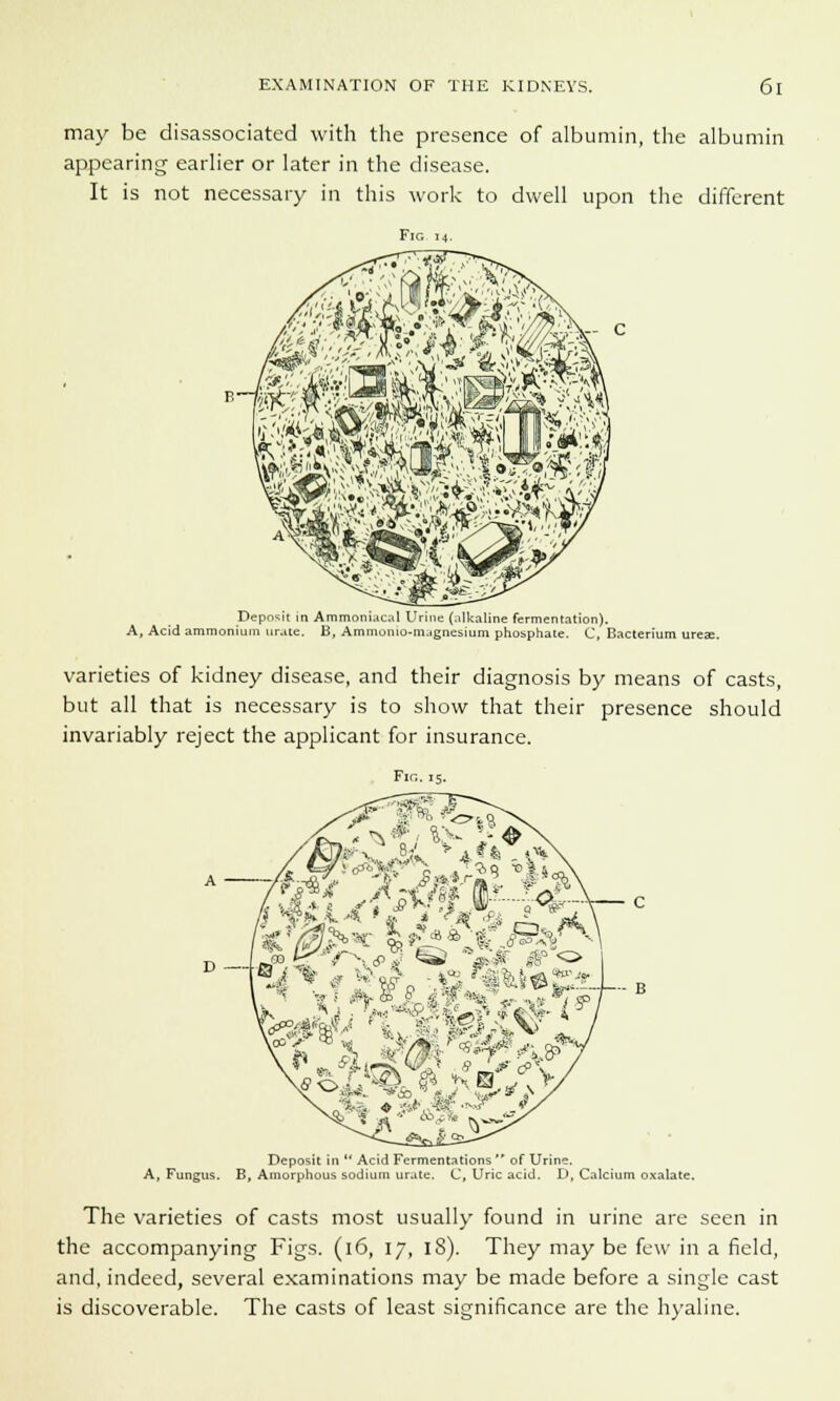 may be disassociated with the presence of albumin, the albumin appearing earlier or later in the disease. It is not necessary in this work to dwell upon the different Deposit in Ammoniaca! Urine (alkaline fermentation). A, Acid ammonium urate. B, Ammonio-magnesium phosphate. C, Bacterium ureae. varieties of kidney disease, and their diagnosis by means of casts, but all that is necessary is to show that their presence should invariably reject the applicant for insurance. Fir.. 15. Wc K, „ - Br # ui},-_ p M ■• ... B \4?0 Deposit in  Acid Fermentations  of Urine. A, Fungus. B, Amorphous sodium urate. C, Uric acid. D, Calcium oxalate. The varieties of casts most usually found in urine are seen in the accompanying Figs. (16, \J, l8). They may be few in a field, and, indeed, several examinations may be made before a single cast is discoverable. The casts of least significance are the hyaline.