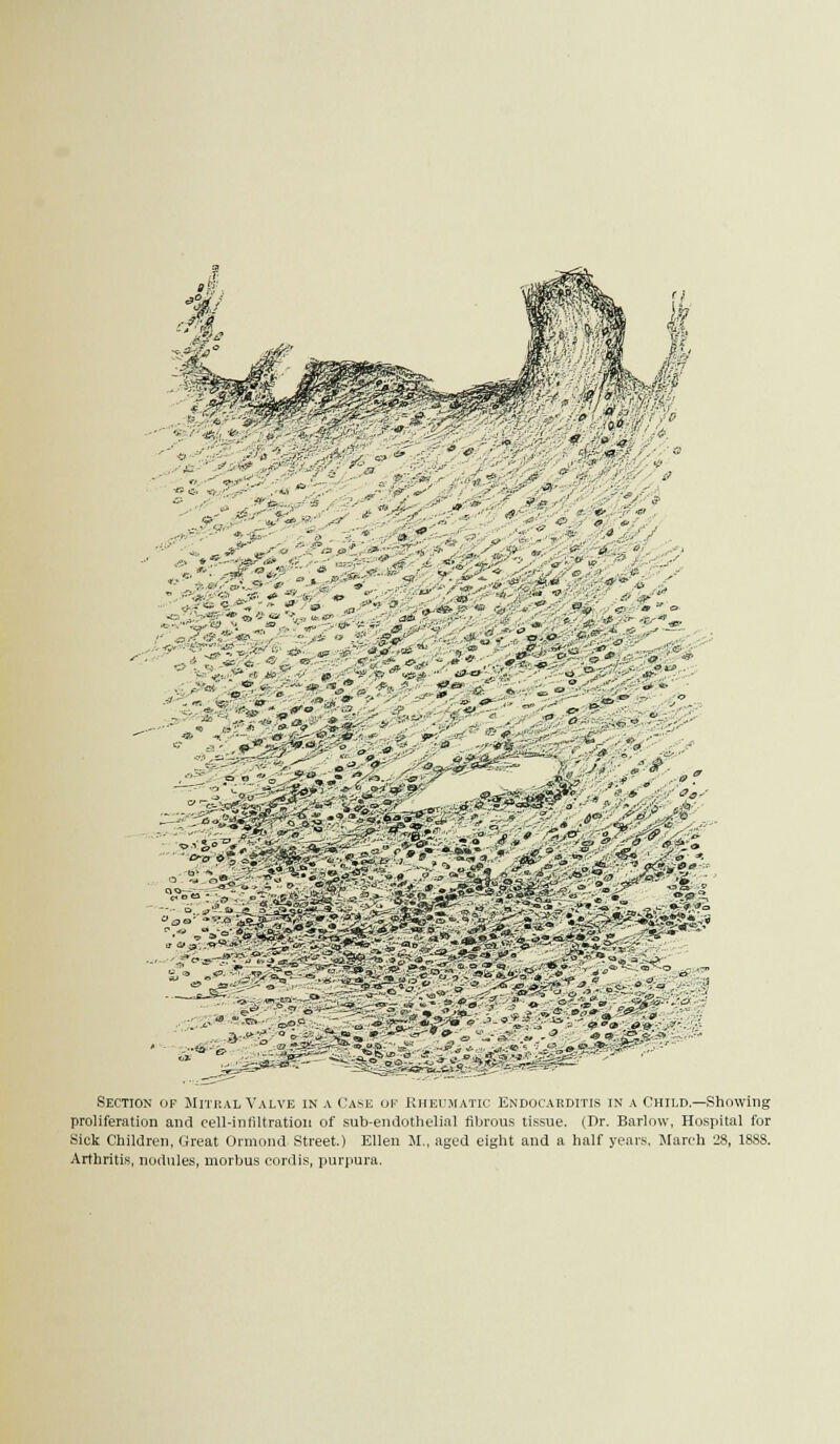 *c» -<■ 0tf -^''-A Section f Mnr al\ \l\e in v(a l i Rhet i\ti L\do \rditi'^ in Thi d—Showing proliferation and cell-inhltration of sub-endothelml fibious tissue. (Dr. Barlow, Hospital for Kick Childrfn. Great Ormond Street.) Ellen M., aged eight and a half years. March 28, 1888. Arthritis, nodules, morbus cordis, purpura.