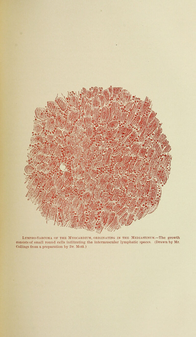 Lympho-Sarcoma or the Myocaedidm, originating in the Mediastinusi.—The growth consists of small round cells infiltrating the intermuscular lymphatic spaces. (Drawn by Mr. CoUings from a preparation hy Dr. Mott.)