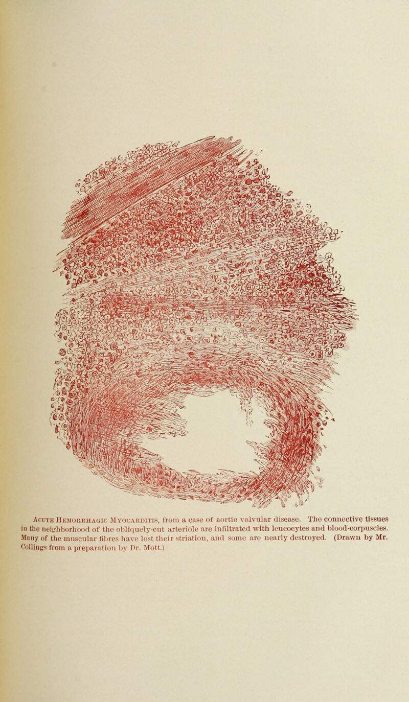 s^ Acute Hemorrhagic Myocarditis, from a case of aortlo valvular disease. The connective tissues iti the neiffhborlioorl of tlio obliquely-cut arteriole are infiltrated with leucocytes and hlood-corpuscles. Many of the muscular fibres have lost their striation, and some are nearly destroyed. (Drawn by Mr. CoUings from a preparation by Dr. Mott.)