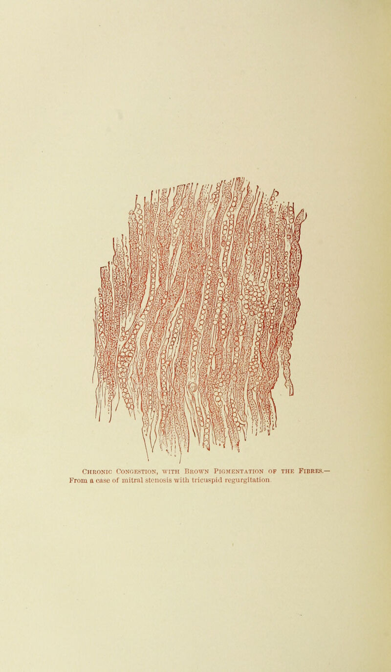 Chronic Conoestion, with Brown Pigmentation of the Fibres.- From a case of mitral stenosis with tricuspid regurgitation.
