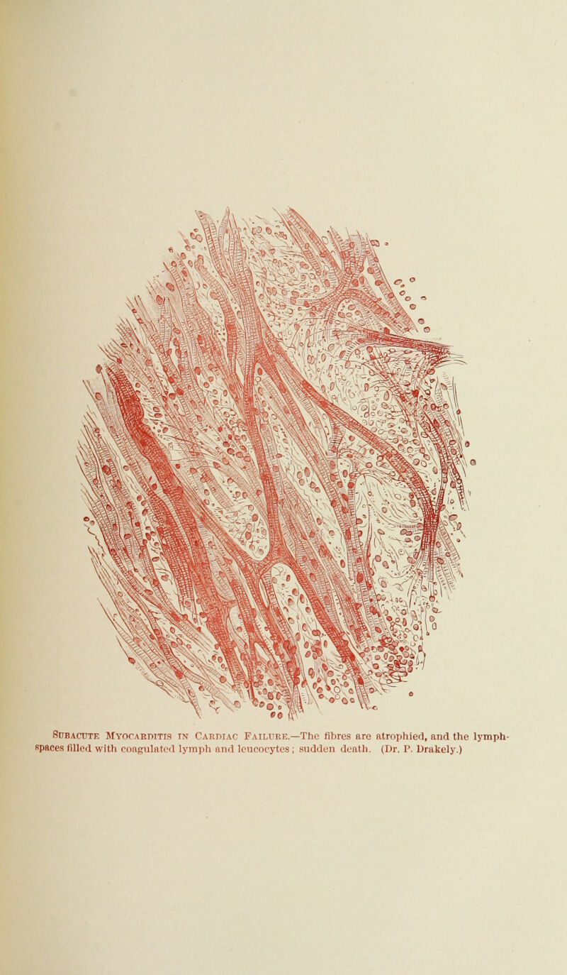 Subacute MvorAKDiTis tn Cardiac Failure.—The fibres are atrophied, and the lymph- spaces filled with coagulated lymph and leucocytes ; sudden death. (Dr. P. Drakely.)