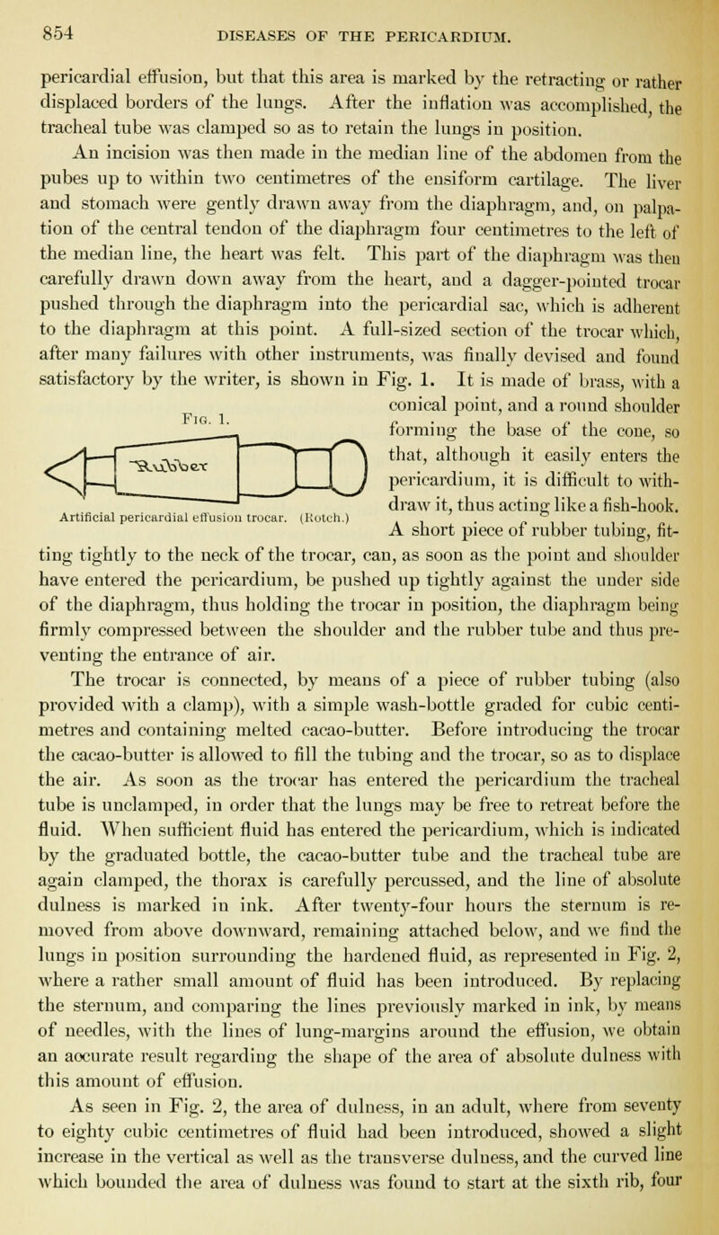 Fig. 1. Artificial pericardial etTusiou trocar. (Kotcli.) 854 DISEASES OF THE PERICARDIUM. pericardial effusion, but that this area is marked by the retracting; or rather displaced borders of the lungs. After the inflation was accomplished the tracheal tube was clamped so as to retain the lungs in position. An incision was then made in the median line of the abdomen from the pubes up to within two centimetres of the ensiform cartilage. The liver and stomach were gently drawn away from the diaphragm, and, on palpa- tion of the central tendon of the diaphragm four centimetres to the left of the median line, the heart was felt. This part of the diaphragm was then carefully drawn down away from the heart, and a dagger-pointed trocar pushed through the diaphragm into the pericardial sac, which is adherent to the diaphragm at this point. A full-sized section of the trocar which after many failures with other instruments, Avas finally devised and found satisfactory by the writer, is shown in Fig. 1. It is made of brass, with a conical point, and a round shoulder forming the base of the cone, so that, although it easily enters the pericardium, it is difficult to with- draw it, thus acting like a fish-hook. A short piece of rubber tubing, fit- ting tightly to the neck of the trocar, can, as soon as the point and slioulder have entered the pericardium, be pushed up tightly against the under side of the diaphragm, thus holding the trocar in position, the diaphragm being firmly compressed between the shoulder and the rubber tube and thus pre- venting the entrance of air. The trocar is connected, by means of a piece of rubber tubing (also provided with a clamp), with a simple wash-bottle graded for cubic centi- metres and containing melted cacao-butter. Before introducing the trocar the cacao-butter is allowed to fill the tubing and the trocar, so as to displace the air. As soon as the trocar has entered the pericardium the tracheal tube is undamped, in order that the lungs may be free to retreat before the fluid. When sufficient fluid has entered the pericardium, \\'hich is indicated by the graduated bottle, the cacao-butter tube and the tracheal tube are again clamped, the thorax is carefully percussed, and the line of absolute dulness is marked in ink. After twenty-four hours the sternum is re- moved from above downward, remaining attached below, and we find the lungs in position surrounding the hardened fluid, as represented in Fig. 2, where a rather small amount of fluid has been introduced. By replacing the sternum, and comparing the lines previously marked in ink, by means of needles, with the lines of lung-margins around the effusion, we obtain an accurate result regarding the shape of the area of absolute dulness with this amount of effusion. As seen in Fig. 2, the area of dulness, in an adult, where from seventy to eighty cubic centimetres of fluid had been introduced, showed a slight increase in the vertical as well as the transverse dulness, and the curved line which bounded the area of dulness was found to start at the sixth rib, four