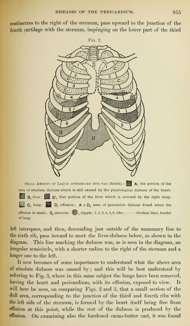 centimetres to the riglit of the sternum, pass upward to the junction of the fourtli cartilage with the sternum, impinging on the lower part of the third Fig. -2. Small Amount of Luji'in introduced into Sac (Rotch).—^g A, the portion of the area of absolute dulness which is still caused by the physiological dulness of the heart; Hill B, liver; m B', 'hat portion of the liver which Is covered by the right lung; ^M C, lung: ^9 D, effusion; A + D, area of percussion dulness found when the eflfusion is small; S, sternum: @), nipple; 1, 2, 3, 4, 5,6, ribs; (broken line), border of lung. left interspace, and then, descending just outside of the mammary line to the sixth rib, pass inward to meet the liver-dulness below, as shown in the diagram. This line marking the dulness was, as is seen in the diagram, an irregular semicircle, with a shorter radius to the right of the sternum and a longer one to the left. It now becomes of some importance to understand what the above area of absolute dulness was caused by; and this will be best understood by referring to Fig. 3, where in this same subject the lungs have been removed, leaving the heart and pericardium, M'ith its effusion, exposed to view. It will jiere be seen, on comparing Figs. 2 and 3, that a small section of the dull area, corresponding to the junction of the third and fourth ribs with the left side of the sternum, is formed by the heart itself being free from effusion at this point, wliile the rest of the dulness is in-oduced by the effusion. On examining also the hardened cacao-butter cast, it was found