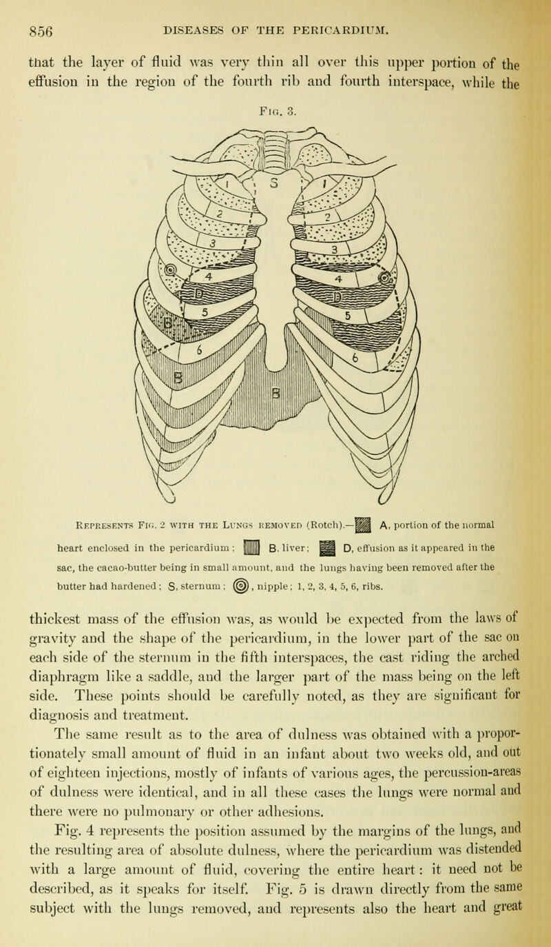 tbat the layer of fluid was very tliin all over this upper portion of the effusion in the region of the fourth rib and fourth interspace, while the Fig. 3. Represents Fii;. 2 with the Lungs removed (Rotcli).—^^ A, portion of the normal heart enclosed in the pericardium ; |]]|]] B. liver; ^a D, effusion as it appeared in the sac, the cacao-butter being in small amount, and the lungs having been removed after the butter had hardened ; S. sternum ; (g), nipple; 1, 2, 3, 4, 5, 6, ribs. thickest mass of the effusion was, as would be expected from the laws of gravity and the shape of the pericardium, in the lower part of the sac on each side of the sternum in the fifth interspaces, the cast riding tlie arched diaphragm like a saddle, and the larger part of the mass being on the left side. These points should be carefully noted, as they are significant for diagnosis and treatment. The same result as to the area of dulness was obtained with a ])iopor- tionately small amount of fluid in an infant about two weeks old, and out of eighteen injections, mo.stly of infants of various ages, the percussion-areas of dulness were identical, and in all these cases the lungs were normal and there were no pulmonary or other adhesions. Fig. 4 represents the jwsition assumed by the margins of the lungs, ana the resulting area of absolute dulness, where the pericardium was distended Avith a large amount of fluid, covering the entire heart: it need not be described, as it speaks for itself Fig. 5 is drawn directly from the same subject with the lungs removed, and represents also the heart and great