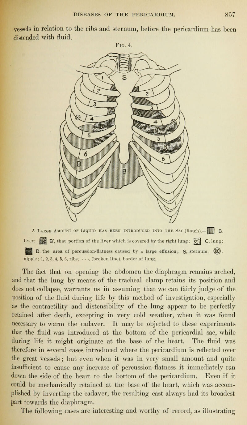 vessels in relation to the ribs and sternum, before the pericardium has been distended with fluid. Fig. 4. A Large AmorNT of Liquid has been introduced into the Sac (Rotch).—|1|] B ^'^*^^' ^^ B', that portion of the liver which is covered by the right lung: f!;;ij Clung: ^a D, the area of percussion-flatness caused by a, large efl'usion; S, sternum: ^), nipplf: 1, 2, 3, 4, 5, C, ribs.- - - -, (broken line), border of lung. The fact that on opening the abdomen the diaphragm remains arched, and that the lung by means of the tracheal clamp retains its position and does not collapse, warrants us in assuming that we can fairly judge of the position of the fluid during life by this method of investigation, especiallj' as the contractility and distensibility of the lung appear to be perfectly retained after death, excepting in very cold weather, when it was found uece.ssary to warm the cadaver. It may be objected to these experiments that the fluid was introduced at the bottom of the pericardial sac, while during life it might originate at the base of the heart. The fluid was therefore in several cases introduced where the pericardium is reflected over the great vessels; but even when it was in very small amount and quite insufficient to cause any increase of percussion-flatness it immediately ran down the side of the heart to tlie bottom of the pericardium. Even if it could be mechanically retained at the base of the heart, which was accom- plished by inverting the cadaver, the resulting cast always had its broadest part towards the diaphragm. The following cases are interesting and worthy of record, as illustrating