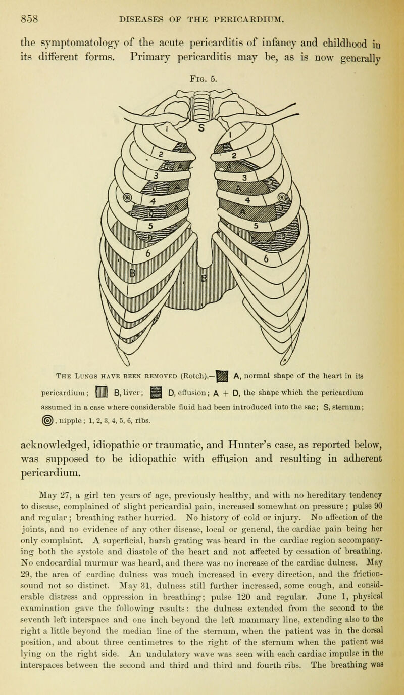 the symptomatology of the acute pericarditis of infancy and childhood in its different forms. Primary pericarditis may be, as is now generally Fig. 5. The Li'NGS have been removed (Rotch).—^H A, normal shape of the heart in its pericardium ; j]||| B, liver; ^| D, effusion; A + D, the shape which the pericardium assumed in a case where considerable fluid had been introduced into the sac; S, sternum; (^ , nipple; 1, 2, 3, i, 5, 6, ribs. acknowledged, idiopathic or traumatic, and Hunter's case, as reported below, was supposed to be idiopathic with efCusion and resulting in adherent pericardium. May 27, a girl ten j'ears of age, previously healthy, and with no hereditary tendency to disease, complained of slight pericardial pain, increased somewhat on pressure; pulse 90 and regular ; breathing rather hurried. No history of cold or injury. No affection of the joints, and no evidence of any other di.sease, local or general, the cardiac pain being her only complaint. A superficial, harsh grating was heard in the cardiac region accompany- ing both the systole and diastole of the heart and not affected by cessation of breathing. No endocardial murmur was heard, and there was no increase of the cardiac dulness. May 29, the area of cardiac dulness was much increased in every direction, and the friction- sound not so distinct. May 31, dulness still further increased, some cough, and consid- erable distress and oppression in breathing; pulse 120 and regular. June 1, physical examination gave the following results: the dulne.ss extended from the second to the seventh left interspace and one inch beyond the left mammary line, extending also to the right a little bej'ond the median line of the sternum, when the patient was in the dorsal position, and about three centimetres to the right of the sternum when the patient was lying on the right side. An undulatory wave was seen with each cardiac impulse in the interspaces between the second and third and third and fourth ribs. The breathing wa«
