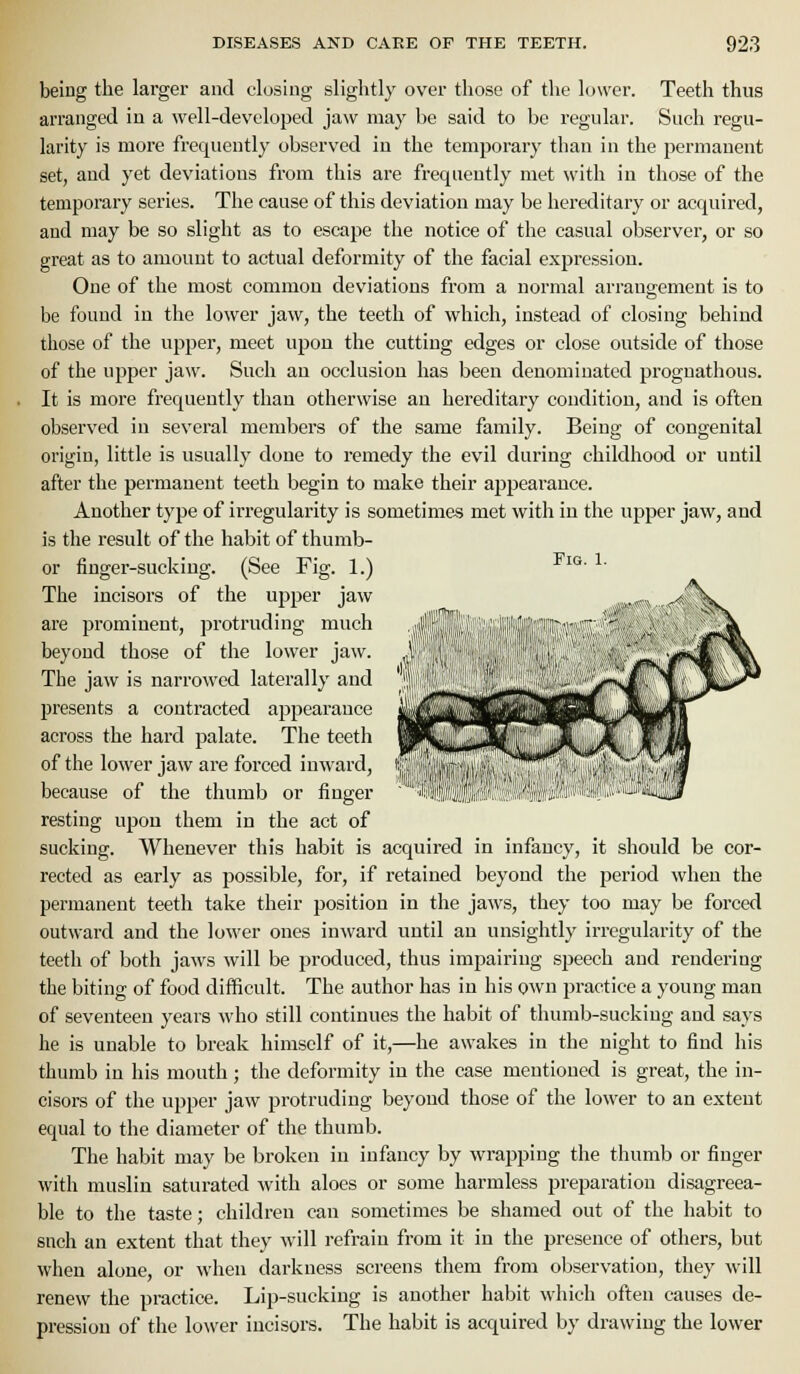 being the larger and closing slightly over those of the hjwer. Teeth thus arranged in a well-devoloped jaw may be said to be regular. Such regu- larity is more frequently observed in the temporary than in the permanent set, and yet deviations from this are frequently met \\'ith iu those of the temporary series. The cause of this deviation may be hereditary or acquired, and may be so slight as to escape the notice of the casual observer, or so great as to amount to actual deformity of the facial expression. One of the most common deviations from a normal arrangement is to be found in the lower jaw, the teeth of which, instead of closing behind those of the upper, meet upon the cutting edges or close outside of those of the upper jaw. Such an occlusion has been denominated prognathous. It is more frequently than otherwise an hereditary condition, and is often observed iu several members of the same family. Being of congenital origin, little is usually done to remedy the evil during childhood or until after the permanent teeth begin to make their appearance. Another type of irregularity is sometimes met with in the upper jaw, and is the result of the habit of thumb- or finger-sucking. (See Fig. 1.) The incisors of the upper jaw are prominent, protruding much beyond those of the lower jaw. The jaw is narrowed laterally and j)resents a contracted appearance across the hard palate. The teeth of the lower jaw are forced inward, because of the thumb or finger resting upon them in the act of sucking. Whenever this habit is acquired in infancy, it should be cor- rected as early as possible, for, if retained beyond the period when the permanent teeth take their position in the jaws, they too may be forced outward and the lower ones inward until an unsightly irregularity of the teeth of both jaws will be produced, thus impairing speech and rendering the biting of food difficult. The author has in his own practice a young man of seventeen years who still continues the habit of thumb-sucking and says he is unable to break himself of it,—he awakes in the night to find his thumb iu his mouth; the deformity in the case mentioned is great, the in- cisors of the upper jaw protruding beyond those of the lower to an extent equal to the diameter of the thumb. The habit may be broken in infancy by wrapping the thumb or finger with muslin saturated with aloes or some harmless preparation disagreea- ble to the taste; children can sometimes be shamed out of the habit to such an extent that they will refrain from it in the presence of others, but when alone, or when darkness screens them from observation, they will renew the practice. Lip-sucking is another habit which often causes de- pression of the lower incisors. The habit is acquired by drawing the lower