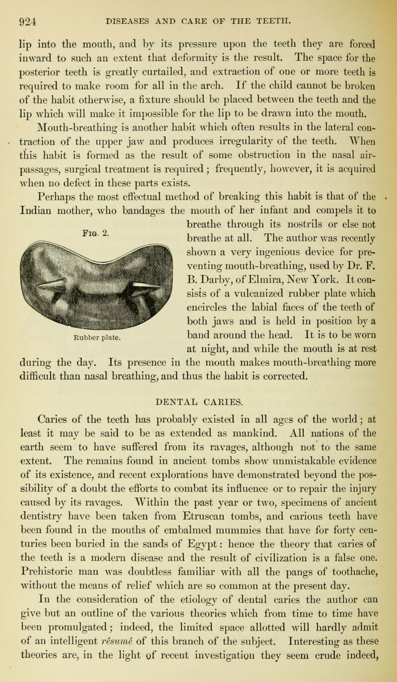 lip into the month, and by its pressnre npon the teeth they are forced inward to such an extent that deformity is the result. The space for the posterior teeth is greatly curtailed, and extraction of one or more teeth is required to make room for all in the arch. If the child cannot be broken of the habit otherwise, a fixture should be placed between the teeth and the lip which will make it impossible for the lip to be drawn into the mouth. Mouth-breathing is another habit which often results in the lateral con- traction of the upper jaw and produces irregularity of the teeth. AVheu this habit is formed as the result of some obstruction in the nasal air- passages, surgical treatment is required; frequently, however, it is acquired when no defect in these parts exists. Perhaps the most effectual method of breaking this habit is that of the Indian mother, who bandages the mouth of her infant and compels it to breathe through its nostrils or else not breathe at all. The author was recently shown a very ingenious device for pre- venting mouth-breathing, used by Dr. F. B. Darby, of Elmira, New York. It con- sists of a vulcanized rubber plate which encircles the labial faces of the teeth of both jaws and is held in position by a band around the head. It is to be worn at night, and while the mouth is at rest during the day. Its presence in the mouth makes mouth-breathing more difficult than nasal breathing, and thus the habit is corrected. Pig. 2. Rubber plate. DENTAL CAKIES. Caries of the teeth has probably existed in all ages of the world; at least it may be said to be as extended as mankind. All nations of the earth seem to have suffered from its ravages, although not to the same extent. The remains found in ancient tombs show unmistakable evidence of its existence, and recent explorations have demonstrated beyond the pos- sibility of a doubt the efforts to combat its influence or to repair the injury caused by its ravages. Within the past year or two, specimens of ancient dentistry have been taken from Etruscan tombs, and carious teeth have been found in the mouths of embalmed mummies that have for forty cen- turies been buried in the sands of Egypt: hence the theory that caries of the teeth is a modern disease and the result of civilization is a false one. Prehistoric man was doubtless familiar with all the pangs of toothache, without the means of relief which are so common at the present day. In the consideration of the etiology of dental caries the author can give but an outline of the various theories which from time to time have been promulgated; indeed, the limited space allotted will hardly admit of an intelligent resume of this branch of the subject. Interesting as these theories are, in the light of recent investigation they seem crude indeed,