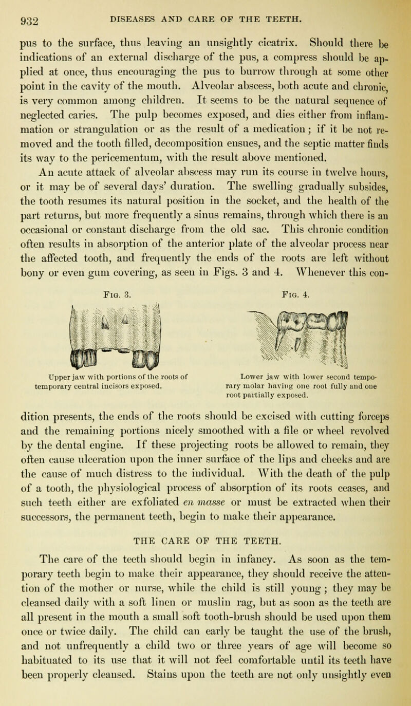 pus to tlie surface, thus leaving an unsightly cicatrix. Should there be iudicatious of an external discharge of the pus, a compress should be ap- plied at once, thus encouraging the pus to burrow through at some other point in the cavity of the mouth. Alveolar abscess, botli acute and chronic, is very common among children. It seems to be the natural sequence of neglected caries. The pulp becomes exposed, and dies either from inflam- mation or strangulation or as tlie result of a medication; if it be not re- moved and the tooth filled, decomposition ensues, and the septic matter finds its way to the pericementum, with the result above mentioned. An acute attack of alveolar abscess may run its course in twelve hours, or it may be of several days' duration. The swelling gradually subsides, the tooth resumes its natural position in the socket, and the health of the part returns, but more frequently a sinus remains, through which there is au occasional or constant discharge from the old sac. This chronic condition often results in absorption of the anterior plate of the alveolar process near the affected tooth, and frequently the ends of the roots are left without bony or even gum covering, as seen in Figs. 3 and 4. Whenever this cou- Fio. 3. Fig. 4. Upper jaw with portions of the roots of temporary central incisors exposed. Lower jaw witli lower second tempo- rary molar having one root fully and one root partially exposed. dition presents, the ends of the roots should be excised with cutting forceps and the remaining portions nicely smoothed with a file or wheel revolved by the dental engine. If these projecting roots be allowed to remain, they often cause ulceration upon the inner surface of the lips and cheeks and are the cause of much distress to the individual. With the death of the pulp of a tooth, the physiological process of absorption of its roots ceases, and such teeth either are exfoliated en masse or must be extracted when their successors, the permanent teeth, begin to make their appearance. THE CARE OP THE TEETH. The care of the teeth should begin in infancy. As soon as the tem- porary teeth begin to make their appearance, they should receive the atten- tion of the mother or nurse, M'bile the cliild is still young; they may be cleansed daily witli a soft linen or muslin rag, but as soon as the teeth are all present in the mouth a small soft tooth-brush should be used upon them once or twice daily. The child can early be taught the use of the brush, and not unfrequently a child two or three years of age will become so habituated to its use that it will not feel comfortable until its teeth have been properly cleansed. Stains upon the teeth are not only luisightly even
