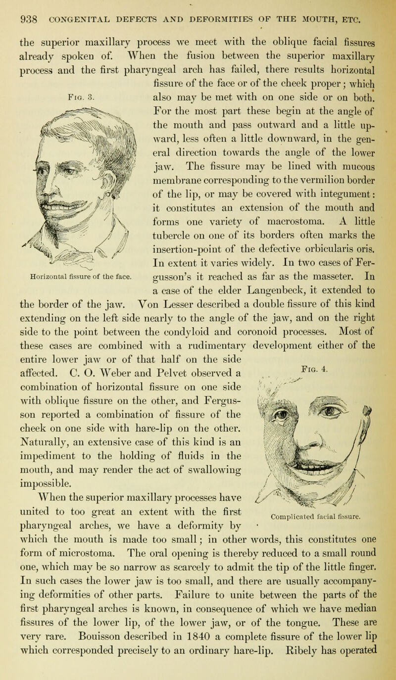 Fio. 3. ;C=i:^ Horizontal fissure of the face. the superior maxillary process we meet with the oblique facial fissures already spokeu of. When the fusion between the superior maxillary process aud the first pharyngeal arch has failed, there results horizontal fissure of the face or of the cheek proper; which also may be met with on one side or on both. For the most part these begin at the angle of the mouth and pass outward and a little up- ward, less often a little downward, in the gen- eral direction towards the angle of the lower jaw. The fissure may be lined with mucous membrane corresponding to the vermilion border of the lip, or may be covered with integument: it constitutes an extension of the mouth and forms one variety of macrostoma. A little tubercle on one of its borders often marks the insertion-point of the defective orbicularis oris. In extent it varies widely. In two cases of Fer- gusson's it reached as far as the masseter. In a case of the elder Laugeubeck, it extended to the border of the jaw. Von Lesser described a double fissure of this kind extending on the left side nearly to the angle of the jaw, and on the right side to the point between the condyloid and coronoid processes. Most of these cases are combined with a rudimentary development either of the entire lower jaw or of that half on the side affected. C. O. Weber and Pelvet observed a combination of horizontal fissure on one side with oblique fissure on the other, and Fergus- son reported a combination of fissure of the cheek on one side with hare-lip on the other. Naturally, an extensive case of this kind is an impediment to the holding of fluids in the mouth, and may render the act of swallowing impossible. When the superior maxillary processes have united to too great an extent with the first pharyngeal arches, we have a deformity by which the mouth is made too small; in other words, this constitutes one form of microstoma. The oral opening is thereby reduced to a small round one, which may be so narrow as scarcely to admit the tip of the little finger. In such cases the lower jaw is too small, and there are usually accompany- ing deformities of other parts. Failure to unite between the parts of the first pharyngeal arches is known, in consequence of which we have median fissures of the lower lip, of the lower jaw, or of the tongue. These are very rare. Bouisson described in 1840 a complete fissure of the lower lip which corresponded precisely to an ordinary hare-lip. Ribely has operated Fig. 4.