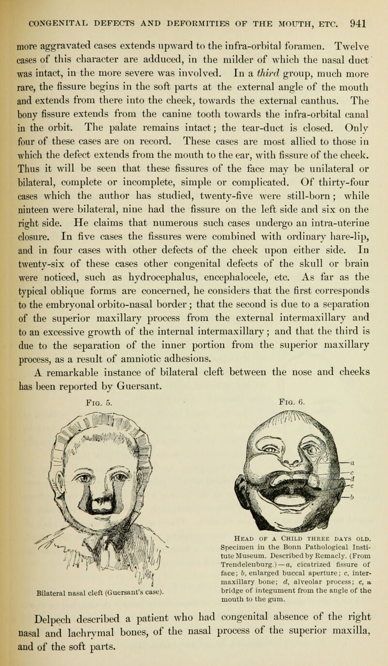 more aggravated cases extends upward to the infra-orbital foramen. Twelve eases of this character are adduced, in the milder of which the uasal duct was intact, in the more severe was involved. In a third group, much more rare, the fissure begins in the soft parts at the external angle of the mouth and extends from there into the cheek, towards the external can thus. The bony fissure extends from the canine tooth towards the infra-orbital canal in the orbit. The palate remains intact; the tear-duct is closed. Only four of these cases are on record. These cases are most allied to those in which the defect extends from the mouth to the ear, with fissure of the cheek. Thus it will be seen that these fissures of the face may be unilateral or bilateral, complete or incomplete, simple or complicated. Of thirty-four cases which the author has studied, twenty-five were still-born; \vhile ninteen were bilateral, nine had the fissure on the left side and six on the right side. He claims that numerous such cases undergo an intra-uteriue closure. In five cases the fissures were combined with ordinary hare-lip, and in four cases with other defects of the cheek upon either side. In twenty-six of these cases other congenital defects of the skull or brain were noticed, such as hydrocephalus, encephalocele, etc. As far as the typical oblique forms are concerned, he considers that the first corresponds to the embryonal orbito-nasal border; that the second is due to a separation of the superior maxillary process from the external intermaxillary and to an excessive growth of the internal intermaxillary; and that the third is due to the separation of the inner portion from the superior maxillary process, as a result of amniotic adhesions. A remarkable instance of bilateral cleft between the nose and cheeks has been reported by Guersant. Fig. 5. • Fig. 6. Bilateral nasal cleft (Guersant's case). Head of a Child three days old. Specimen in the Bonn Pathological Insti- tute Museum. Described by Remacly. (From Trendelenburg.) — a, cicatrized fissure of face; b, enlarged buccal aperture; e. inter- maxillary bone; d, alveolar process; e, u bridge of integument from the angle of the mouth to the gum. Delpech described a patient who had congenital absence of the right nasal and lachrymal bones, of the nasal process of the superior maxilla, and of the soft parts.