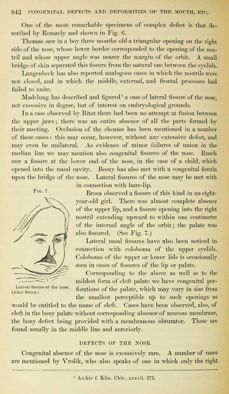 One of the most remarkable specimens of complex defect is that de- scribed by Remacly and shown in Fig. 6. Thomas saw in a boy three months old a triangular opening on the right side of the nose, whose lower border corresponded to the opening of the nos- tril and whose upper angle was nearer the margin of the orbit. A small bridge of skin separated this fissure from the natural one between the eyelids. Langenbeck has also reported analogous cases in which the nostrils were not closed, and in which the middle, external, and frontal processes had failed to unite. Madeluug has described and figured' a case of lateral fissure of the nose, not excessive in degree, but of interest on embrj'ological grounds. In a case observed by Bitot there had been no attempt at fusion between the upper jaws; there was an entire absence of all the parts formed by their meeting. Occlusion of the choanae has been mentioned in a number of these cases: this may occur, however, without any extensive defect, and may even be unilateral. As evidence of minor failures of union iu the median line we may mention also congenital fissures of the nose. Rusch saw a fissure at the lower end of the nose, in the case of a child, which opened into the nasal cavity. Beeny has also met with a congenital fistula upon the bridge of the nose. Lateral fissures of the nose may be met with in connection with hare-lip. Broca observed a fissure of this kind in an eight- year-old girl. There was almost complete absence of the upper lip, and a fissure opening into the right nostril extending upward to within one centimetre of the internal angle of the orbit; the palate was also fissured. (See Fig. 7.) Lateral nasal fissures have also been noticed in connection with coloboma of the upper eyelids. Coloboma of the upper or lower lids is occasionally seen in cases of fissures of the lip or palate. Corresjjonding to the above as well as to the mildest form of cleft palate we have congenital per- forations of the palate, which may vary in size from the smallest perceptible Up to such openings as would be entitled to the name of cleft. Cases have been observed, also, of cleft in the bony palate without corresponding absence of mucous membrane, the bony defect being provided with a membranous obturator. These are found usually in the middle line and anteriorly. Fig. 7. Lateral fissure of the uose. (After Broca.) DEFECTS OF THE NOSE. Congenital absence of the nose is excessively rare. A number of cases are mentioned by Vrolik, who also speaks of one in which only the right