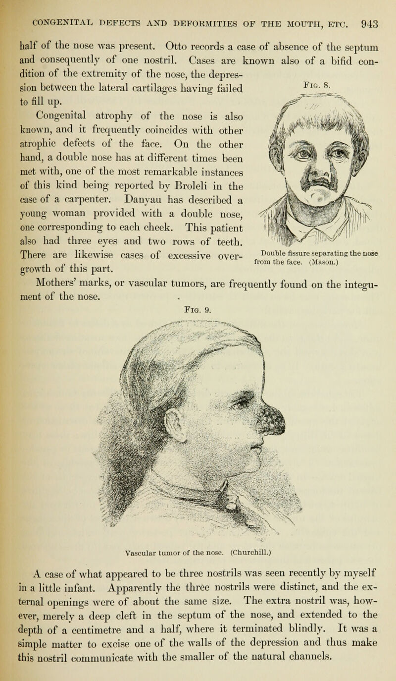 i««—^'^Ci, CONGENITAL DEFECTS AND DEFORMITIES OF THE MOUTH, ETC. 943 half of the nose was present. Otto records a case of absence of the septum and consequently of one nostril. Cases are known also of a bifid con- dition of the extremity of the nose, the depres- sion between the lateral cartilages having failed to fill up. Congenital atrophy of the nose is also known, and it frequently coincides with other atrophic defects of the face. On the other hand, a double nose has at different times been met with, one of the most remarkable instances of this kind being reported by Broleli in the case of a carpenter. Danyau has described a young woman provided with a double nose, one corresponding to each cheek. This patient also had three eyes and two rows of teeth. There are likewise cases of excessive over- growth of this part. Mothers' marks, or vascular tumors, are frequently found on the integu ment of the nose. Fig. 9. Double fissure separating the uose from the face. (Mason.) Vascular tumor of the nose. (Churchill.) A case of what appeared to be three nostrils was seen recently by myself in a little infant. Apparently the three nostrils were distinct, and the ex- ternal openings were of about the same size. The extra nostril was, how- ever, merely a deep cleft in the septum of the nose, and extended to the depth of a centimetre and a half, where it terminated blindly. It was a simple matter to excise one of the walls of the depression and thus make this nostril conmiunicate with the smaller of the natural channels.