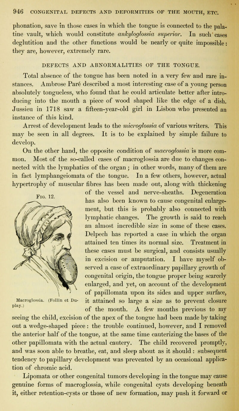 FlO. 12. phonation, save in those eases in which the tongue is connected to the pala- tine vault, which would constitute ankyloglossia superior. In such cases deglutition and the other functions would be nearly or quite impossible: they are, however, extremely rare. DEFECTS AND ABNORMALITIES OF THE TONGUE. Total absence of the tongue has been noted in a very few and rare in- stances. Ambrose Pare described a most interesting case of a yotnig person absolutely tongueless, who found that he could articulate better after intro- ducing into the mouth a piece of wood shaped like the edge of a dish. Jussieu in 1718 saw a fifteen-yeai'-old girl in Lisbon who presented an instance of this kind. Arrest of development leads to the microglossia of various writers. This may be seen in all degrees. It is to be explained by simple failure to develop. On the other hand, the opposite condition of macroglossia is more com- mon. Most of the so-called cases of macroglossia are due to changes con- nected with the lymphatics of the organ ; in other words, many of them are in fact lymphangeiomata of the tongue. In a few others, however, actual hypertrophy of muscular fibres has been made out, along with thickening of the vessel and nerve-sheaths. Degeneration has also been known to cause congenital enlarge- ment, but this is probably also connected with lymphatic changes. The growth is said to reach an almost incredible size in some of these cases. Delpech has reported a case in which the organ attained ten times its normal size. Treatment in these cases must be surgical, and consists usually in excision or amputation. I have myself ob- served a case of extraordinary papillary growth of congenital origin, the tongue proper being scarcely enlarged, and yet, on account of the development of papillomata upon its sides and upper surface, it attained so large a size as to prevent closure of the mouth. A few months previous to my seeing the child, excision of the apex of the tongue had been made by taking out a wedge-shaped piece : the trouble continued, however, and I removed the anterior half of the tongue, at the same time cauterizing the bases of the other papillomata with the actual cautery. The child recovered promptly, and was soon able to breathe, eat, and sleep about as it should : subsequent tendency to papillary development was prevented by an occasional applica- tion of chromic acid. Lipomata or other congenital tumors developing in the tongue may cause genuine forms of macroglossia, while congenital cysts developing beneath it, either retention-cysts or those of new formation, may push it forward or Macroglossia, play.) (Follin et Du-