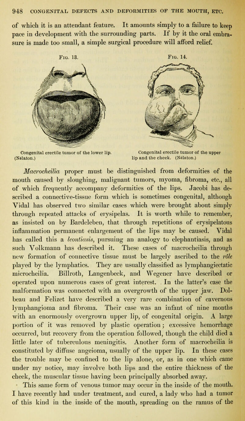 of which it is au attendant feature. It amounts simply to a failure to keep pace in development with the surrounding parts. If by it the oral embra- sure is made too small, a simple surgical procedure will afford relief. Fio. 13. Fig. 14. Congenital erectile tumor of the lower lip. (Nslaton.) Congenital erectile tumor of the upper lip and the cheelj. (Nelaton.) Macrocheilia proper must be distinguished from deformities of the mouth caused by sloughing, malignant tumors, myoma, fibroma, etc., all of which frequently accompany deformities of the lips. Jacobi has de- scribed a connective-tissue form which is sometimes congenital, although Vidal has observed two similar cases which were brought about simply through repeated attacks of eiysipelas. It is worth while to remember, as insisted on by Bardeleben, that through repetitions of erysipelatous inflammation permanent enlargement of the lips may be caused. Vidal has called this a leontiasis, pursuing an analogy to elephantiasis, and as such Volkmann has described it. These cases of macrocheilia through new formation of connective tissue must be largely ascribed to the rdle played by the lymphatics. They are usually classified as lymphangiectatic microcheilia. Billroth, Langenbeck, and Wegener have described or operated upon numerous cases of great interest. In the latter's case the malformation was connected with an overgrowth of the upper jaw. Dol- beau and Felizet have described a very rare combination of cavernous lymphangioma and fibroma. Their case was an infant of nine months with an enormously overgrown upper lip, of congenital origin. A large portion of it was removed by plastic operation ; excessive hemorrhage occurred, but recovery from the operation followed, though the child died a little later of tuberculous meningitis. Another form of macrocheilia is constituted by diffuse angeioma, usually of the upper Vip. In these cases the trouble may be confined to the lip alone, or, as in one which came under my notice, may involve both lips and the entire thickness of the cheek, the muscular tissue having been principally absorbed away. ■ This same form of venous tumor may occur in the inside of the mouth. I have recently had under treatment, and cured, a lady who had a tumor of this kind in the inside of the mouth, spreading on the ramus of the