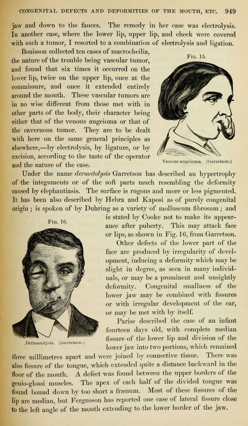 FiQ. 15. Venous angeioma. (Garretson.) jaw and down to the fauces. The remedy in her case was electrolysis. In another case, where the lower lij), upper lip, and cheek were covered with such a tumor, I resorted to a combination of electrolysis and ligation. Bouisson collected ten cases of niacroeheilia, the nature of the trouble being vascular tumor, and found that six times it occurred on the lower lip, twice on the upper lip, once at the commissure, and once it extended entirely around the mouth. These vascular tumors are iu no wise difierent from those met with in other parts of the body, their character being either that of the venous angeioma or that of the cavernous tumor. They are to be dealt with here on the same general principles as elsewhere,—by electrolysis, by ligature, or by excision, according to the taste of the operator and the nature of the case. Under the name dermntolysis Garretson has described an hypertrophy of the integuments or of the soft parts much resembling the deformity caused by elephantiasis. The surface is rugous and more or less pigmented. It has been also described by Hebra and Kaposi as of purely congenital origin ; is spoken of by Duhring as a variety of molluseum fibrosum ; and is stated by Cooke not to make its appear- ance after puberty. This may attack face or lips, as shown in Fig. 16, from Garretson. Other defects of the lower part of the face are produced by irregularity of devel- opment, inducing a deformity which may be slight in degree, as seen in many individ- uals, or may be a prominent and unsightly deformity. Congenital smalluess of the lower jaw may be combined with fissures or with irregular development of the ear, or may be met with by itself Parise described the case of an infant fourteen days old, with complete median fissure of the lower lip and division of the lower jaw into two portions, which remained three millimetres apart and were joined by connective tissue. There was also fissure of the tongue, which extended quite a distance backward in the floor of the month. A defect was found between the upper borders of the genio-glossi muscles. The apex of each half of the divided tongue was found bound down by too short a fnenum. Most of these fissures of the lip are median, but Fergusson has reported one case of lateral fissure close to the left angle of the mouth extending to the lower border of the jaw. Fig. 16. DermalolyMS. (Garretsuu.)
