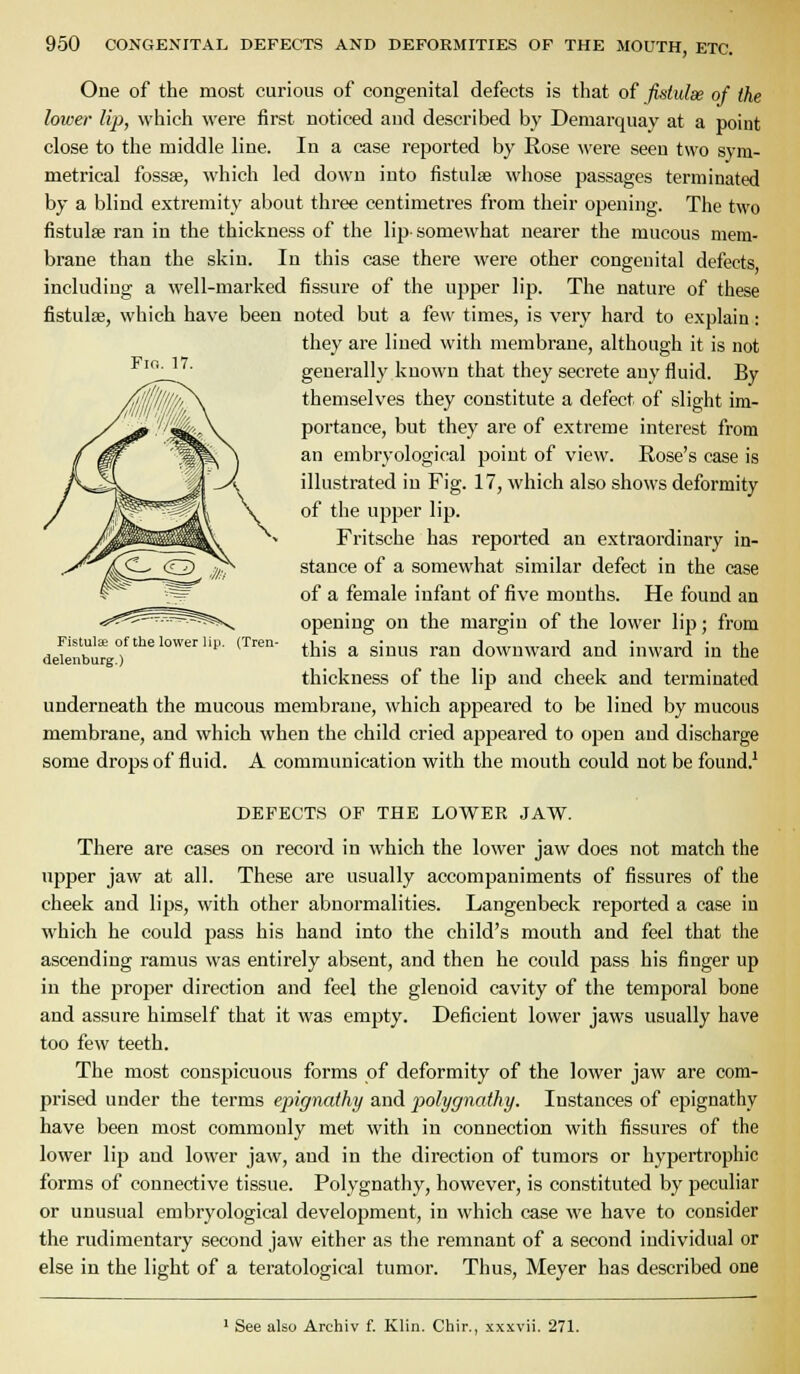 One of the most curious of congenital defects is that of fktulae of the lower lip, which were first noticed and described by Demarquay at a point close to the middle line. In a case reported by Rose were seen two sym- metrical fossae, which led down into fistulae whose passages terminated by a blind extremity about three centimetres from their opening. The two fistulae ran in the thickness of the lip- somewhat nearer the mucous mem- brane than the skin. In this case there were other congenital defects including a well-marked fissure of the upper lip. The nature of these fistulae, which have been noted but a few times, is very hard to explain: they are lined with membrane, although it is not ' generall)'known that they secrete any fluid. By themselves they constitute a defect of slight im- portance, but they are of extreme interest from an embryological point of view. Rose's case is illustrated in Fig. 17, which also shows deformity of the upper lip. Fritsche has reported an extraordinary in- stance of a somewhat similar defect in the case of a female infant of five months. He found an opening on the margin of the lower lip; from deiinb^irgr''' '''' *^'^ ^ ^'''^ ^^ downward and inward in the thickness of the lip and cheek and terminated underneath the mucous membrane, which appeared to be lined by mucous membrane, and which when the child cried appeared to open and discharge some drops of fluid. A communication with the mouth could not be found.^ DEFECTS OF THE LOWER JAW. There are cases on record in which the lower jaw does not match the upper jaw at all. These are usually accompaniments of fissures of the cheek and lips, with other abnormalities. Langenbeck reported a case in which he could pass his hand into the child's mouth and feel that the ascending ramus was entirely absent, and then he could pass his finger up in the proper direction and feel the glenoid cavity of the temporal bone and assure himself that it was empty. Deficient lower jaws usually have too few teeth. The most conspicuous forms of deformity of the lower jaw are com- prised under the terms epignathy and polygnathy. Instances of epignathy have been most commonly met with in connection with fissures of the lower lip and lower jaw, and in the direction of tumors or hypertrophic forms of connective tissue. Polygnathy, however, is constituted by peculiar or unusual embryological development, in which case we have to consider the rudimentary second jaw either as the remnant of a second individual or else in the light of a teratological tumor. Thus, Meyer has described one ' See also Archiv f. Klin. Chir., xxxvii. 271.