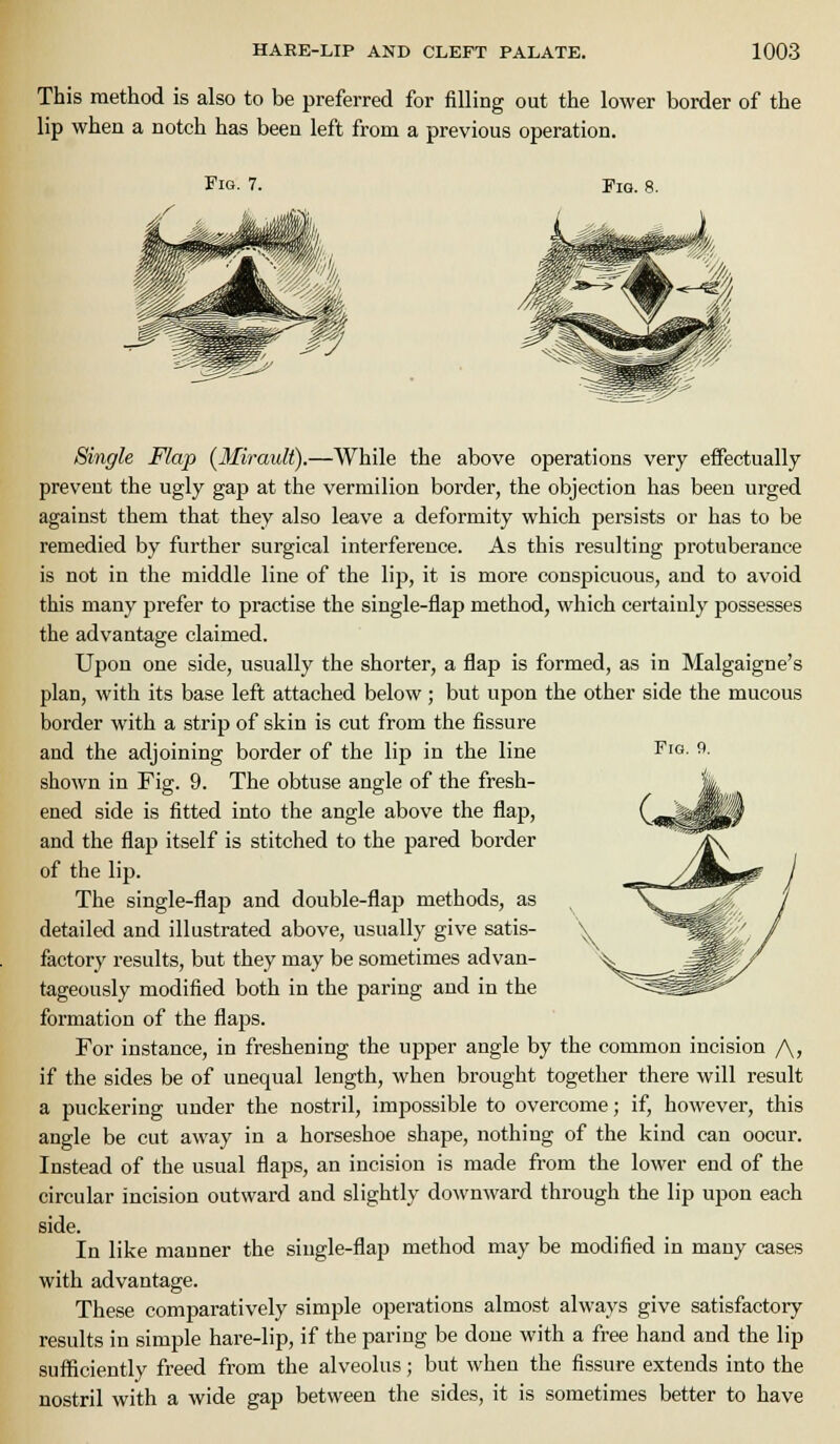 This method is also to be preferred for filling out the lower border of the lip when a notch has been left from a previous operation. Fig. 7. Pig. 8. Fig. 9. Single Flap {Mirault).—While the above operations very effectually prevent the ugly gap at the vermilion border, the objection has been urged against them that they also leave a deformity which persists or has to be remedied by further surgical interference. As this resulting protuberance is not in tlie middle line of the lip, it is more conspicuous, and to avoid this many prefer to practise the single-flap method, which certainly possesses the advantage claimed. Upon one side, usually the shorter, a flap is formed, as in Malgaigne's plan, with its base left attached below; but upon the other side the mucous border with a strip of skin is cut from the fissure and the adjoining border of the lip in the line shown in Fig. 9. The obtuse angle of the fresh- ened side is fitted into the angle above the flap, and the flap itself is stitched to the pared border of the lip. The single-flap and double-flap methods, as detailed and illustrated above, usually give satis- factory results, but they may be sometimes advan- tageously modified both in the paring and in the formation of the flaps. For instance, in freshening the upper angle by the common incision /\, if the sides be of unequal length, when brought together there will result a puckering under the nostril, impossible to overcome; if, however, this angle be cut away in a horseshoe shape, nothing of the kind can occur. Instead of the usual flaps, an incision is made from the lower end of the circular incision outward and slightly downward through the lip upon each side. In like manner the single-flap method may be modified in many cases with advantage. These comparatively simple operations almost always give satisfactory results in simple hare-lip, if the paring be done with a free hand and the lip sufficiently freed from the alveolus; but when the fissure extends into the nostril with a wide gap between the sides, it is sometimes better to have