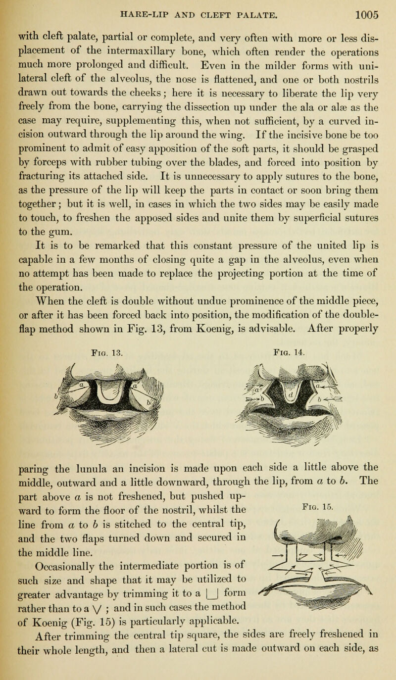 with cleft palate, partial or complete, aud very often with more or less dis- placement of the intermaxillary bone, which often render the operations much more prolonged and difficult. Even in the milder forms with uni- lateral cleft of the alveolus, the nose is flattened, and one or both nostrils drawn out towards the cheeks; here it is necessary to liberate the lip very freely from the bone, carrying the dissection up under the ala or alse as the case may require, supplementing this, when not sufficient, by a curved in- cision outward through the lip around the wing. If the incisive bone be too prominent to admit of easy apposition of the soft parts, it should be grasped by forceps with rubber tubing over the blades, aud forced into position by fracturing its attached side. It is unnecessary to apply sutures to the bone, as the pressure of the lip will keep the parts in contact or soon bring them together; but it is well, in cases in which the two sides may be easily made to touch, to freshen the apposed sides aud unite them by superficial sutures to the gum. It is to be remarked that this constant pressure of the united lip is capable in a few months of closing quite a gap in the alveolus, even when no attemjjt has been made to replace the projecting portion at the time of the operation. When the cleft is double without undue prominence of the middle piece, or after it has been forced back into position, the modification of the double- flap method shown in Fig. 13, from Koenig, is advisable. After properly Fio. 13. Fig. 14. Fig. 15. paring the lunula an incision is made upon each side a little above the middle, outward aud a little downward, through the lip, from a to 6. The part above a is not freshened, but pushed up- ward to form the floor of the nostril, whilst the line from a to 6 is stitched to the central tip, and the two flaps turned down and secured in the middle line. Occasionally the intermediate portion is of such size and shape that it may be utilized to greater advantage by trimming it to a ] | form rather than to a V 5 and in such cases the method of Koenig (Fig. 15) is particularly applicable. After trimming the central tip square, the sides are freely freshened in their whole length, and then a lateral cut is made outward on each side, as