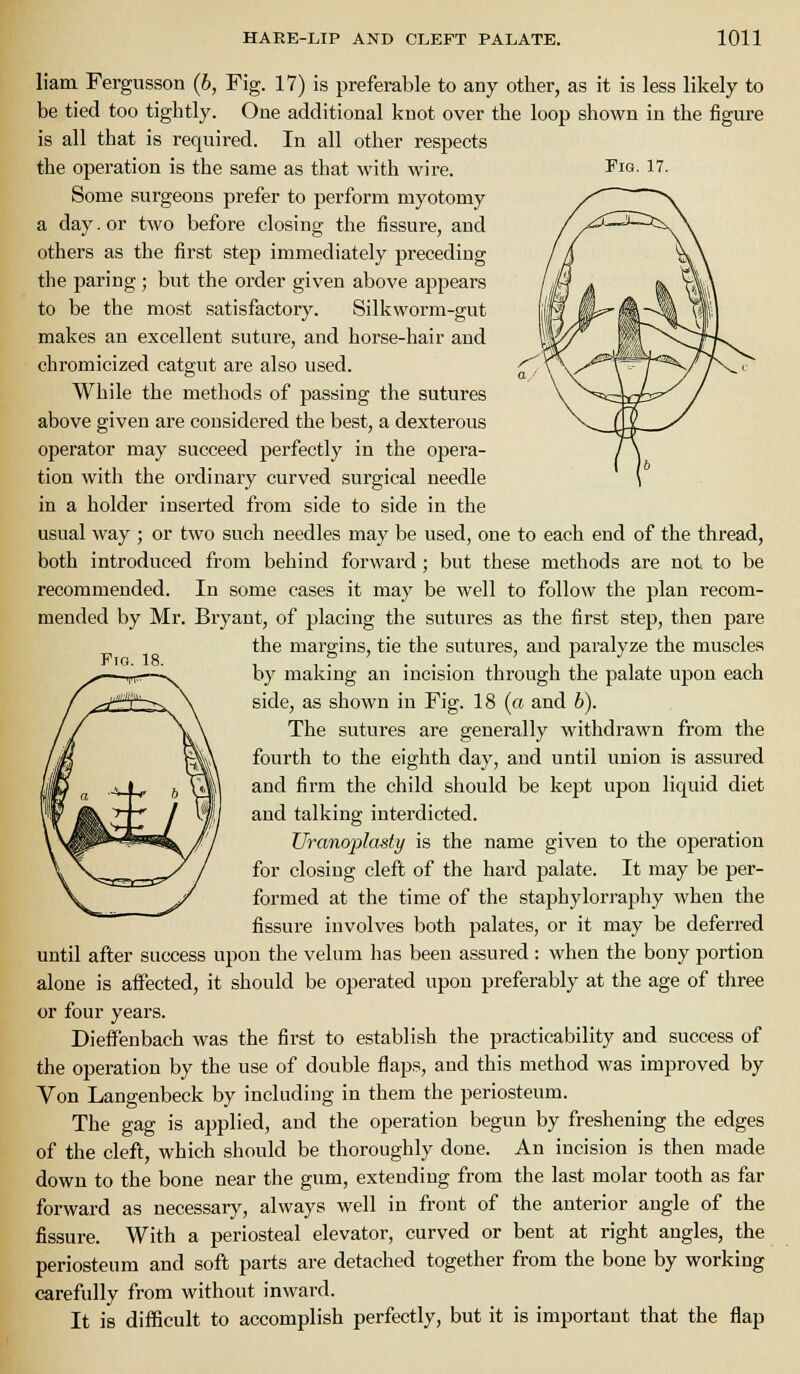 Fig. 17. Fio. 18. liam Fergusson (6, Fig. 17) is preferable to any other, as it is less likely to be tied too tightly. One additional knot over the loop shown in the figure is all that is required. In all other respects the operation is the same as that with wire. Some surgeons prefer to perform myotomy a day. or two before closing the fissure, and others as the first step immediately preceding the paring ; but the order given above appears to be the most satisfactory. Silkworm-gut makes an excellent suture, and horse-hair and chromicized catgut are also used. While the methods of passing the sutures above given are considered the best, a dexterous operator may succeed perfectly in the opera- tion with the ordinary curved surgical needle in a holder inserted from side to side in the usual way ; or two such needles may be used, one to each end of the thread, both introduced from behind forward; but these methods are not to be recommended. In some cases it may be well to follow the plan recom- mended by Mr. Bryant, of placing the sutures as the first step, then pare the margins, tie the sutures, and paralyze the muscles by making an incision through the palate upon each side, as shown in Fig. 18 (a and h). The sutures are generally withdrawn from the fourth to the eighth day, and until union is assured and firm the child should be kept upon liquid diet and talking interdicted. Uranoplasty is the name given to the operation for closing cleft of the hard palate. It may be per- formed at the time of the stajahylorraphy when the fissure involves both palates, or it may be deferred until after success upon the velum has been assured : when the bony portion alone is affected, it should be operated upon preferably at the age of three or four years. DiefFenbach was the first to establish the practicability and success of the operation by the use of double flaps, and this method was improved by Von Langenbeck by including in them the periosteum. The gag is applied, and the operation begun by freshening the edges of the clefl:, which should be thoroughly done. An incision is then made down to the bone near the gum, extending from the last molar tooth as far forward as necessary, always well in front of the anterior angle of the fissure. With a periosteal elevator, curved or bent at right angles, the periosteum and soft parts are detached together from the bone by working carefully from without inward. It is difficult to accomplish perfectly, but it is important that the flap