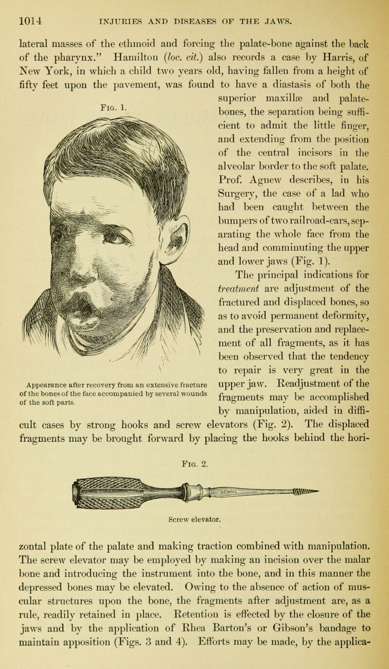 lateral masses of tlie ethnioid aud forcing the palate-bone against the back of the pharynx. Hamilton (loc. cit.) also records a ease by Harris, of New York, in which a child two years old, having fallen from a height of fifty feet upon the jjavement, was found to have a diastasis of both the superior maxillre and palate- bones, the separation being suffi- cient to admit the little fing;er, and extending from the position of the ceutral incisors in the alveolar border to the soft palate. Prof. Agnew describes, in his Surgery, the case of a lad who had been caught between the bumpers of two railroad-cars, sep- arating the whole face from the head and comminuting the upper and lower jaws (Fig. 1). The principal indications for treatment are adjustment of the fi-actured and displaced bones, so as to avoid permanent deformity, and the preservation and replace- ment of all fragments, as it lias been observed that the tendency to repair is very great in the upper jaw. Readjustment of the fragments may be accomplished by manipulation, aided in diffi- cult cases by strong hooks and screw elevators (Fig. 2). The displaced fragments may be brought forward by placing the hooks behind the hori- Appearance after recovery from an extensive fracture of the bones of the face accompanied by several wounds of the soft parts. Fig. 2. Screw elevator. zontal plate of the palate and making traction combined with manipulation. The screw elevator may be employed by making an incision over the malar bone and introducing the instrument into the bone, and in this manner the depressed bones may be elevated. Owing to the absence of action of mus- cular structures upon the bone, the fragments after adjustment are, as a rule, readily retained in place. Retention is effected by the closure of the jaws and by the application of Rhea Barton's or Gibson's bandage to maintain apposition (Figs. 3 and 4). Efforts may be made, by the applica-