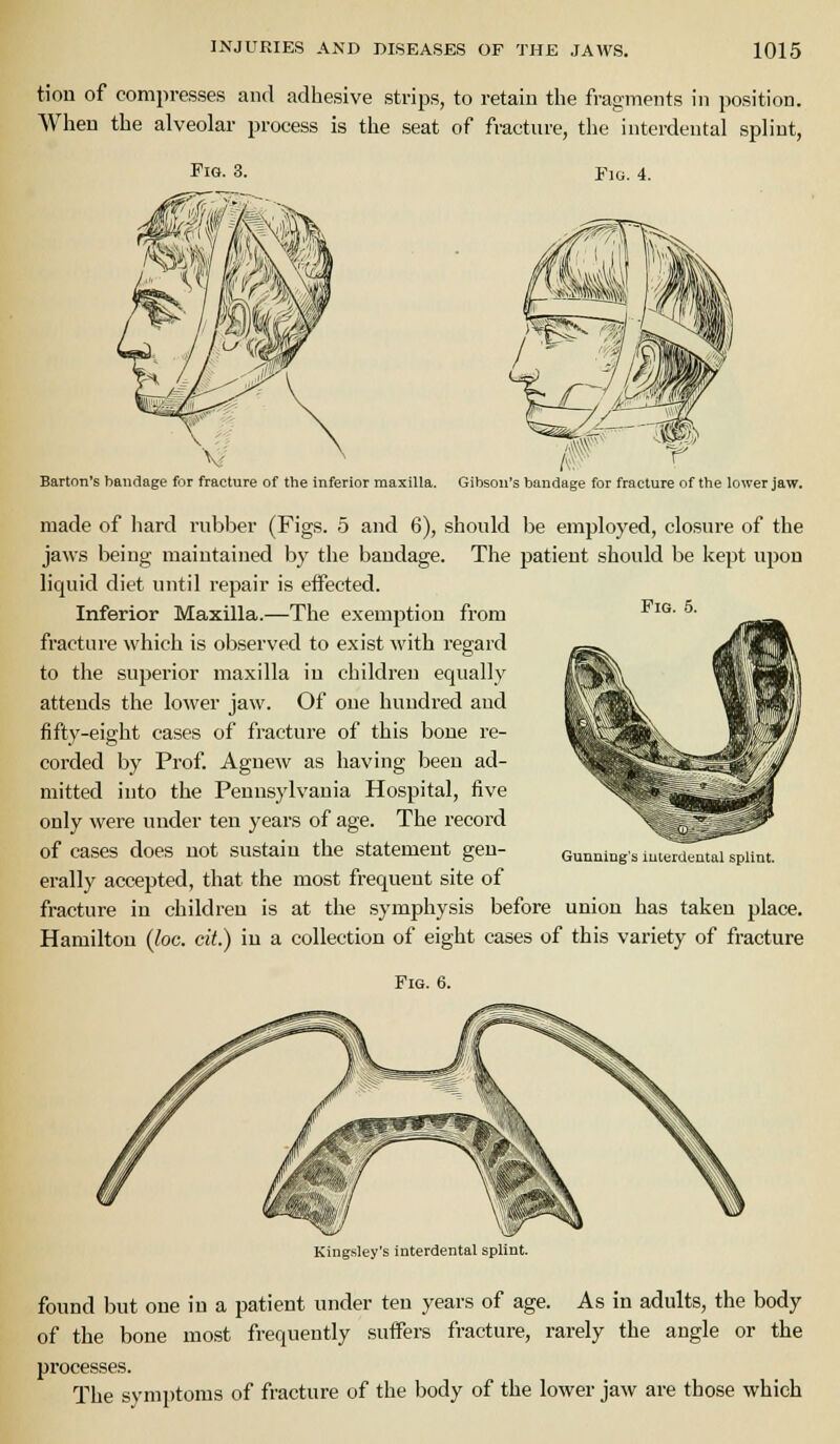 tion of compresses and adhesive strips, to retain the fragments in position. When the alveolar process is the seat of fracture, the interdental splint, Fig. 3. Fig. 4. Fig. 5. Barton's bandage for fracture of the inferior maxilla. Gibson's bandage for fracture of the lower jaw. made of hard rubber (Figs. 5 and 6), should be employed, closure of the jaws being maintained by the bandage. The patient should be kept upon liquid diet until repair is effected. Inferior Maxilla.—The exemption from fracture which is observed to exist with regard to the superior maxilla in children equally attends the lower jaw. Of one hundred and fifty-eight cases of fractui'e of this bone re- corded by Prof. Agnew as having been ad- mitted into the Pennsylvania Hospital, five only were under ten years of age. The record of cases does not sustain the statement gen- erally accepted, that the most frequent site of fracture in children is at the symphysis before union has taken place. Hamilton {loc. cit.) in a collection of eight cases of this variety of fracture Fig. 6. Gunning's iuterclental splint. Kingsley's interdental splint. found but one in a patient under ten years of age. As in adults, the body of the bone most frequently suffers fracture, rarely the angle or the processes. The symptoms of fracture of the body of the lower jaw are those which