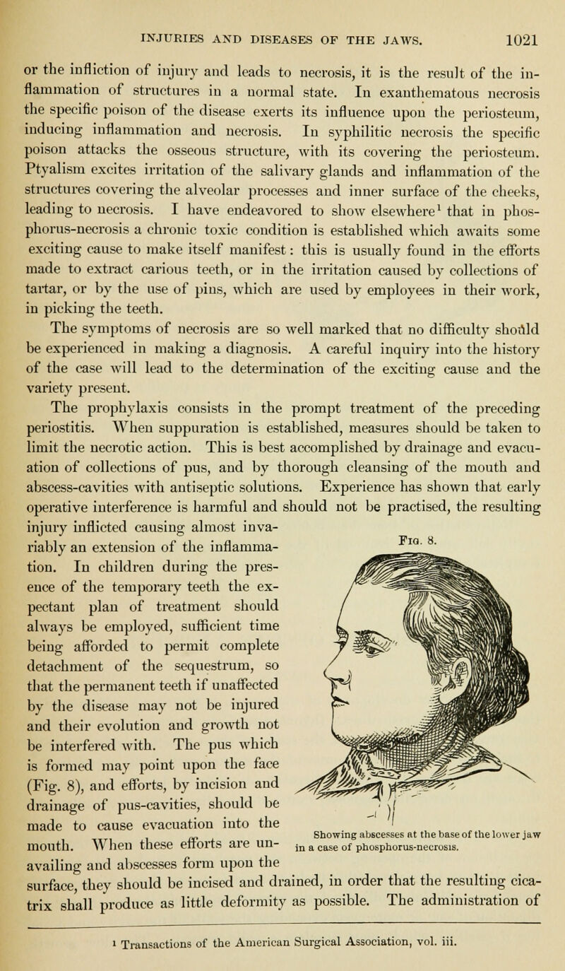 or the infliction of injury and leads to necrosis, it is the result of the in- flammation of structures in a normal state. In exanthematous neci-osis the specific poison of the disease exerts its influence upon the periosteum, inducing inflammation and necrosis. In syphilitic necrosis the specific poison attacks the osseous structure, with its covering the periosteum. Ptyalism excites irritation of the salivary glands and inflammation of the structures covering the alveolar processes and inner surface of the cheeks, leading to necrosis. I have endeavored to show elsewhere* that in phos- phorus-necrosis a chronic toxic condition is established which awaits some exciting cause to make itself manifest: this is usually found in the efforts made to extract carious teeth, or in the irritation caused by collections of tartar, or by the use of pins, which are used by employees in their work, in picking the teeth. The symptoms of necrosis are so well marked that no difficulty shoilld be experienced in making a diagnosis. A careful inquiry into the history of the case will lead to the determination of the exciting cause and the variety present. The prophylaxis consists in the prompt treatment of the preceding periostitis. When suppuration is established, measures should be taken to limit the necrotic action. This is best accomplished by drainage and evacu- ation of collections of pus, and by thorough cleansing of the mouth and abscess-cavities with antiseptic solutions. Experience has shown that early operative interference is harmful and should not be practised, the resulting injury inflicted causing almost inva- riably an extension of the inflamma- '° ' tion. In children during the pres- ence of the temporary teeth the ex- pectant plan of treatment should always be employed, sufficient time being afforded to permit complete detachment of the sequestrum, so that the permanent teeth if unaffected by the disease may not be injured and their evolution and growth not be interfered with. The pus which is formed may point upon the face (Fig. 8), and efforts, by incision and drainage of pus-cavities, should be made to cause evacuation into the mouth. When these efforts are un- availing and abscesses form upon the surface, they should be incised and drained, in order that the resulting cica- trix shall produce as little deformity as possible. The administration of Showing abscesses at the base of the lower jaw in a case of phosphorus-necrosis. ' Transactions of the American Surgical Association, vol. iii.