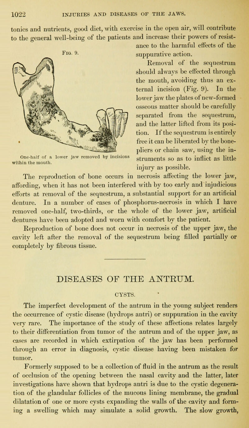 tonics and nutrients, good diet, with exercise in the open air, will contribute to the general well-being of the patients and increase their powers of resist- ance to the harmful effects of the Fi**- ^- suppurative action. Removal of the sequestrum should always be effected through the mouth, avoiding thus an ex- ternal incision (Fig. 9). In the lower jaw the plates of new-formed osseous matter should be carefully separated from the sequestrum, and the latter lifted from its posi- tion. If the sequestrum is entirely free it can be liberated by the boue- pliers or chain saw, using the in- struments so as to inflict as little injury as possible. The reproduction of bone occurs in necrosis affecting the lower jaw, affording, when it has not been interfered with by too early and injudicious efforts at removal of the sequestrum, a substantial support for an artificial denture. In a number of cases of phosphorus-necrosis in which I have removed one-half, two-thirds, or the whole of the lower jaw, artificial dentures have been adopted and worn with comfort by the patient. Reproduction of bone does not occur in necrosis of the upper jaw, the cavity left after the removal of the sequestrum being filled partially or completely by fibrous tissue. One-half of a lower jaw removed by incisions witliin the mouth. DISEASES OF THE AITTETJM. CYSTS. The imperfect development of the antrum in the young subject renders the occurrence of cystic disease (hydrops antri) or suppuration in the cavity very rare. The importance of the study of these affections relates largely to their differentiation from tumor of the antrum and of the upper jaw, as cases are recorded in which extirpation of the jaw has been performed through an error in diagnosis, cystic disease having been mistaken for tumor. Formerly supposed to be a collection of fluid in the antrum as the result of occlusion of the opening between the nasal cavity and the latter, later investigations have shown that hydrops antri is due to the cystic degenera- tion of the glandular follicles of the mucous lining membrane, the gradual dilatation of one or more cysts expanding the walls of the cavity and form- ing a swelling which may simulate a solid growth. The slow growth,