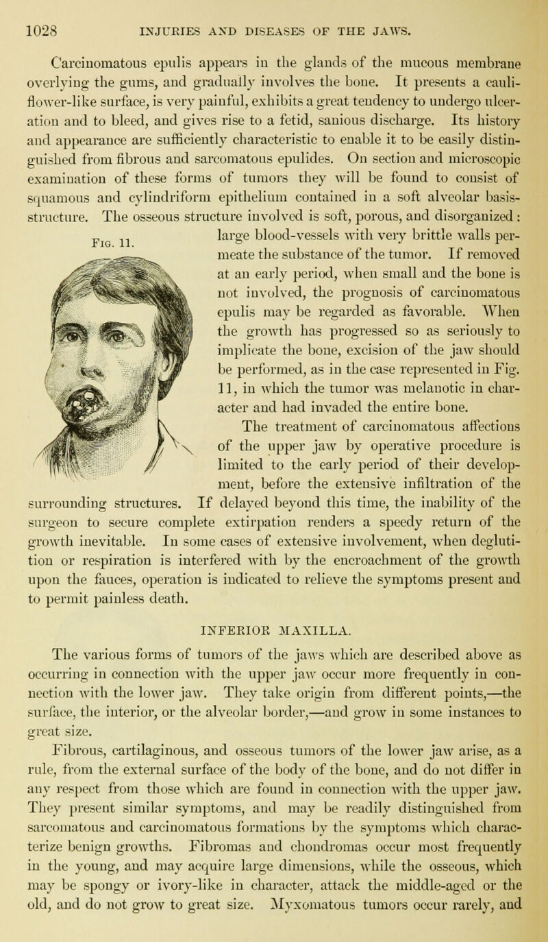 Fig. 11. Carcinomatous epulis appears in the glands of the mucous membrane overlying the gums, and gradually involves the bone. It presents a cauli- flower-like surface, is very painful, exhibits a great tendency to undergo ulcer- ation and to bleed, and gives rise to a fetid, sauious discharge. Its history and appearance are sufficiently cliaracteristic to enable it to be easily distin- guished from fibi'ous and sarcomatous epulides. On section and microscopic examination of these forms of tumors they will be found to consist of squamous and c3diudriform epithelium contained in a soft alveolar basis- structure. The osseous structure iuvolved is soft, porous, and disorganized : large blood-vessels with very brittle walls per- meate the substance of the tumor. If removed at an early period, when small and the bone is not involved, the prognosis of carcinomatous epulis may be regarded as favorable. When the growth has progressed so as seriously to implicate the bone, excision of the jaw should be performed, as in the case represented in Fig. 11, in which the tumor was melanotic in char- acter and had invaded the entire bone. The treatment of carcinomatous affections of the upper jaw by operative procedure is limited to the early period of their develop- ment, before the extensive infiltration of the surrounding structures. If delayed beyoucl this time, the inability of the surgeon to secure complete extirpation renders a speedy return of the growth inevitable. In some cases of extensive involvement, when degluti- tion or respiration is interfered with by the encroachment of the growth upon the fauces, operation is indicated to I'clieve the symptoms present and to permit painless death. INFEEIOR MAXILLA. The various forms of tumors of the jaws which are described above as occurring in connection with the upper jaw occur more frequently in con- nection with the lower jaw. They take origin from different points,—the surface, the intei*ior, or the alveolar border,—and grow in some instances to great size. Fibrous, cartilaginous, and osseous tumors of the lower jaw arise, as a rule, from tlie external surface of the body of the bone, and do not differ in any respect from those which are found in connection with the upper jaw. They present similar symptoms, and may be readily distinguished from sarcomatous and carcinomatous formations Ijy the symptoms which charac- terize benign growths. Fibromas and chondromas occur most frequently in the young, and may acquire large dimensions, while the osseous, which may be .spongy or ivory-like in character, attack the middle-aged or the old, and do not grow to great size. Myxomatous tumors occur rarely, and