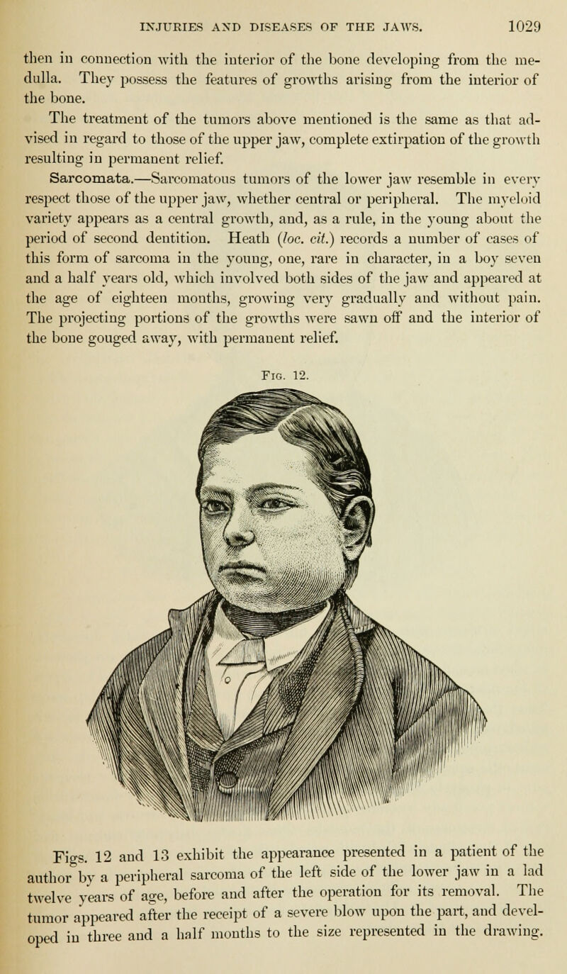 then in connection with the interior of the bone developing from the me- dulla. They possess the features of growths arising from the interior of the bone. The treatment of the tumors above mentioned is the same as that ad- vised in regard to those of the upper jaw, complete extirpation of the growth resulting in permanent relief Sarcomata.—Sarcomatous tumors of the lower jaw resemble in every respect those of the upper jaw, whether central or peripheral. The myeloid variety appears as a central growth, and, as a rule, in the young about the period of second dentition. Heath (loc. cit.) records a number of cases of this form of sarcoma in the young, one, rare in character, in a boy seven and a half years old, which involved both sides of the jaw and appeared at the age of eighteen months, growing very gradually and without pain. The projecting portions of the growths were sawn off and the interior of the bone gouged away, with permanent relief. Fig. 12. Figs. 12 and 13 exhibit the appearance presented in a patient of the author by a peripheral sarcoma of the left side of the lower jaw in a lad twelve years of age, before and after the operation for its removal. The tumor appeared after the receipt of a severe blow upon the part, and devel- oped in three and a half months to the size represented in the drawing.