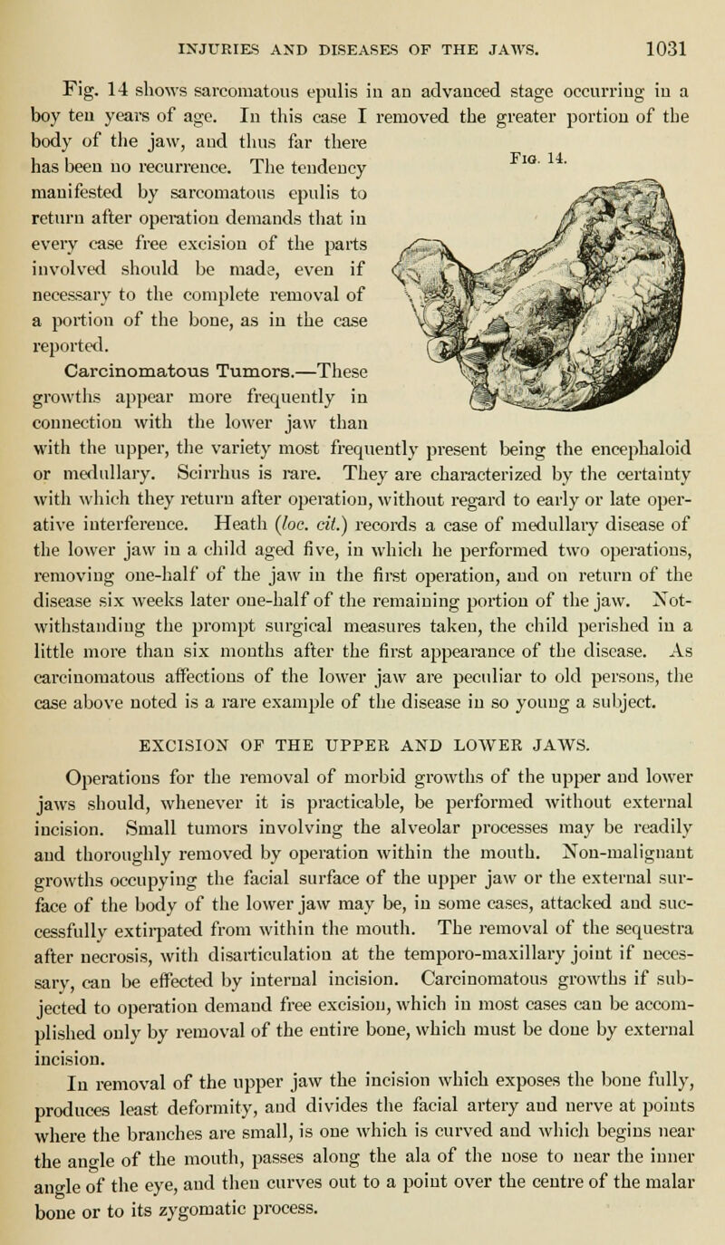 Fio. 14. Fig. 14 shows sarcomatous epulis in an advanced stage occurring in a boy ten years of age. In this case I removed the greater portion of the body of tlie jaw, and thus far there has been no recurrence. The tendency manifested by sarcomatous epulis to return after operation demands that in every case free excisiou of the parts involved should be made, even if necessary to the complete removal of a portion of the bone, as in the case reported. Carcinomatous Tumors.—These growths appear more frequently in connection with the lower jaw than with the upper, the variety most frequently present being the encephaloid or meflullary. Scirrhus is rare. They are characterized by the certainty with which they return after operation, without regard to early or late oper- ative interference. Heath {Joe. cit.) records a case of medullary disease of the lower jaw in a child aged five, in which he performed two operations, removing one-half of the jaw in the first operation, and on return of the disease six weeks later one-half of the remaining portion of the jaw. Not- withstanding the prompt surgical measures taken, the child perished in a little more than six months after the first appearance of the disease. As carcinomatous affections of the lower jaw are peculiar to old persons, tlie case above noted is a rare example of the disease in so young a subject. EXCISION OF THE UPPER AND LOWER JAWS. Operations for the removal of morbid growths of the upper and lower jaws should, whenever it is practicable, be performed without external incision. Small tumors involving the alveolar processes may be readily and thoroughly removed by operation within the mouth. Non-malignant growths occupying the facial surface of the upper jaw or the external sur- face of the body of the lower jaw may be, in some cases, attacked and suc- cessfully extiqiated from within the mouth. The removal of the sequestra after necrosis, with disarticulation at the temporo-maxillary joint if neces- sary, can be effected by internal incision. Carcinomatous growths if sub- jected to operation demand free excisiou, which in most cases can be accom- plished only by removal of the entire bone, which must be done by external incision. In removal of the upper jaw the incision which exposes the bone fully, produces least deformity, and divides the facial artery and nerve at points where the branches are small, is one which is curved and which begins near the ano-le of the mouth, passes along the ala of the nose to near the inner angle of the eye, and tiien curves out to a point over the centre of the malar bone or to its zygomatic process.
