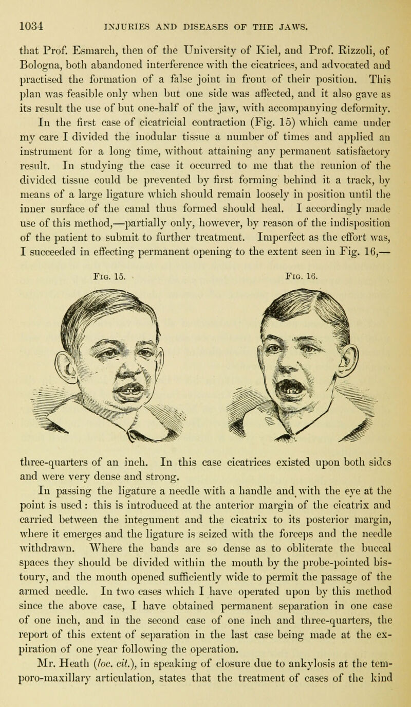that Prof. Esmarch, tlieu of the University of Kiel, aud Prof. Rizzoli, of Bologua, botli abandoued iuterfereuce with the cicatrices, and advocated aud practised the formation of a false joint in front of their position. This ])lan was feasible only when but one side was aifected, and it also gave as its i-esult the use of but one-half of tlie jaw, with accompanying deformity. In the first case of cicatricial contraction (Fig. 15) which came under my care I divided the inodular tissue a number of times and applied an instrument for a long time, witliout attaining any permanent satisfactory result. In studying the case it occurred to nae that the reunion of the divided tissue could be prevented by first forming behind it a track, by means of a large ligature which should remain loosely in position until tlie inner surface of the canal thus formed should heal. I accordingly made use of this method,—partially only, however, b}^ reason of the indisposition of the patient to submit to further treatment. Imperfect as the effort was, I succeeded in effecting permanent opening to the extent seen in Fig. 16,— Pig. 15. Fig. 16. three-quarters of an inch. In this case cicatrices existed upon both sides and were very dense and strong. In passing the ligature a needle with a handle andwith the eye at the point is used: this is introduced at the anterior margin of the cicatrix aud carried between the integument and the cicatrix to its posterior margin, where it emerges and the ligature is seized with the forceps aud the needle withdrawn. Where the bands are so dense as to obliterate the buccal spaces they should be divided within the mouth by the probe-pointed bis- toury, and the month opened sufficiently wide to permit the passage of tlie armed needle. In two cases \vliich I have opei-ated upon by this method since the above case, I have obtained permanent separation in one case of one inch, aud in the second case of one inch and three-quarters, the report of this extent of separation in the last case being made at the ex- piration of one year following the operation. Mr. Heath {loc. cit.), in speaking of closure due to ankylosis at the tcm- poro-maxillary articulation, states that the treatment of cases of the kind