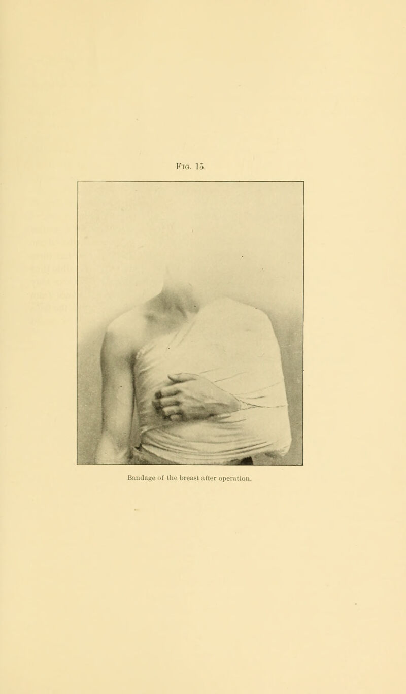 Fig. 15. Bandage of the breast after operation.