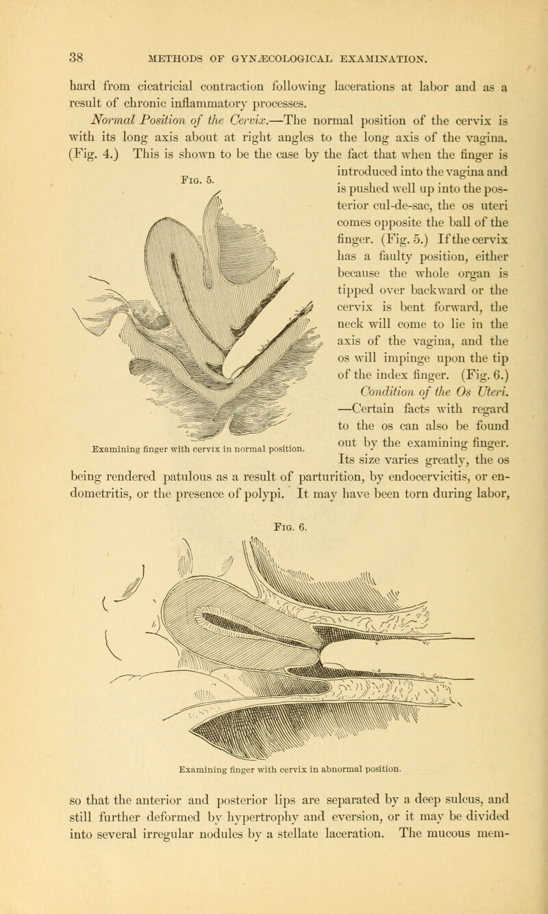 hard from cicatricial contraction following lacerations at labor and as a result of chronic inflammatory processes. Normal Position of the Cervix.—The normal position of the cervix is with its long axis about at right angles to the long axis of the vagina. (Fig. 4.) This is shown to be the case by the fact that when the finger is „ introduced into the vagina and Fig. 5. . . . . *=>. is pushed well up into the pos- terior cul-de-sac, the os uteri comes opposite the ball of the finger. (Fig. 5.) If the cervix has a faulty position, either because the whole organ is tipped over backward or the cervix is bent forward, the neck will come to lie in the axis of the vagina, and the os will impinge upon the tip of the index finger. (Fig. 6.) Condition of the Os Uteri. —Certain facts with regard to the os can also be found out bv the examining finger. Its size varies greatly, the os being rendered patulous as a result of parturition, by endocervicitis, or en- dometritis, or the presence of polypi. It may have been torn during labor, Examining finger with cervix in normal position. Fig. 6. Examining finger with cervix in abnormal position. so that the anterior and posterior lips are separated by a deep sulcus, and still further deformed by hypertrophy and eversion, or it may be divided into several irregular nodules bv a stellate laceration. The mucous mem-